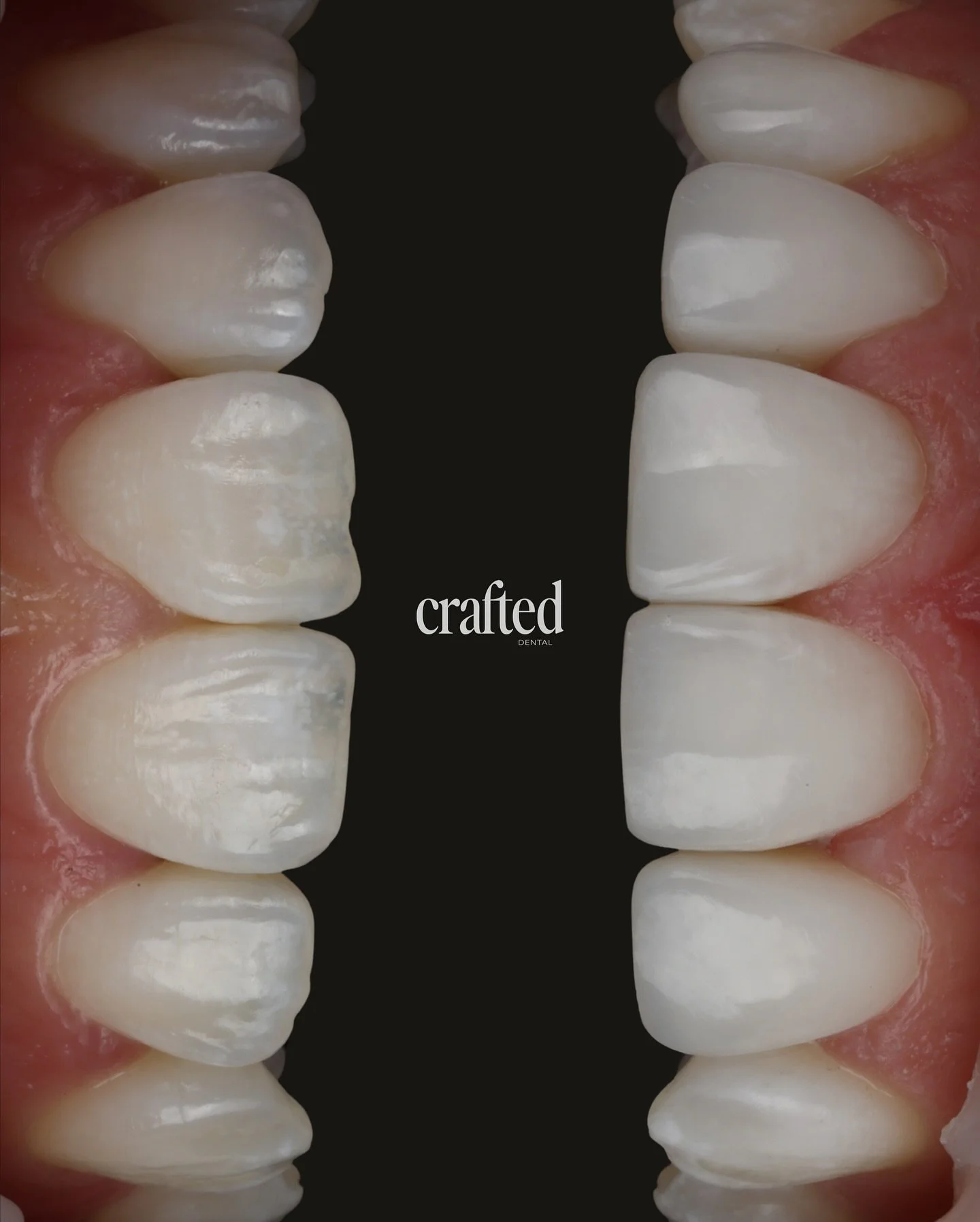 A subtle reshape with a big impact ✨
This patient came to us wanting a smoother, more uniform smile &mdash; the worn edges, white patches and uneven textures were affecting both appearance and confidence.

At Crafted Dental, we refined her smile usin