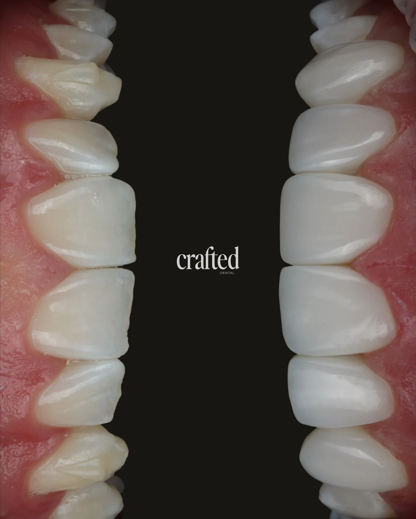 A smile transformation done properly, with a custom plan built from day one ✨

This patient came to Crafted Dental for a full, structured smile journey: Invisalign, whitening, and composite bonding. All mapped out at his very first consultation. No s