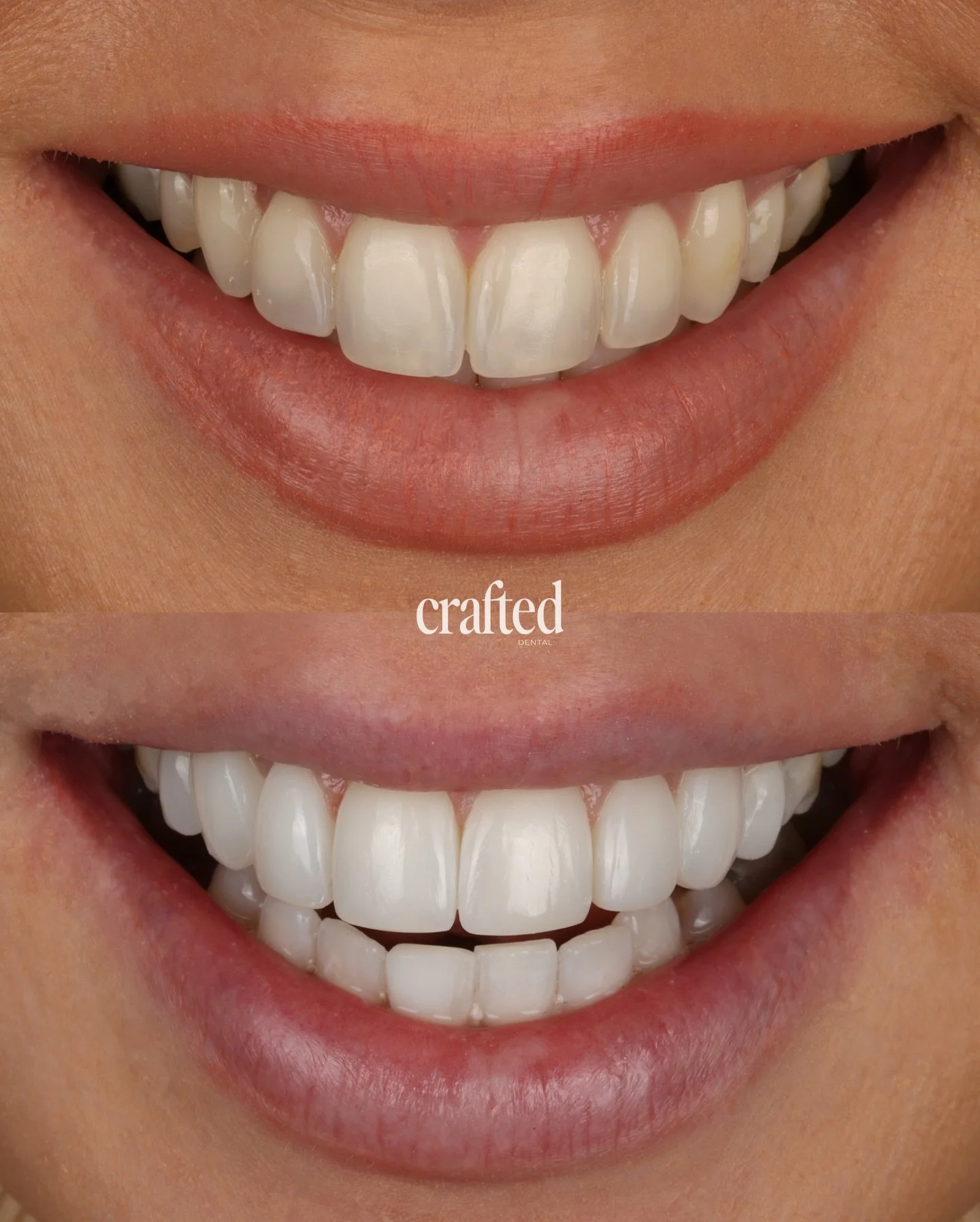 A smile transformation that finally delivers the result she hoped for ✨

This patient came to us after previously having composite bonding done elsewhere a year ago, but felt disappointed, as it looked like nothing had really changed. She still lacke