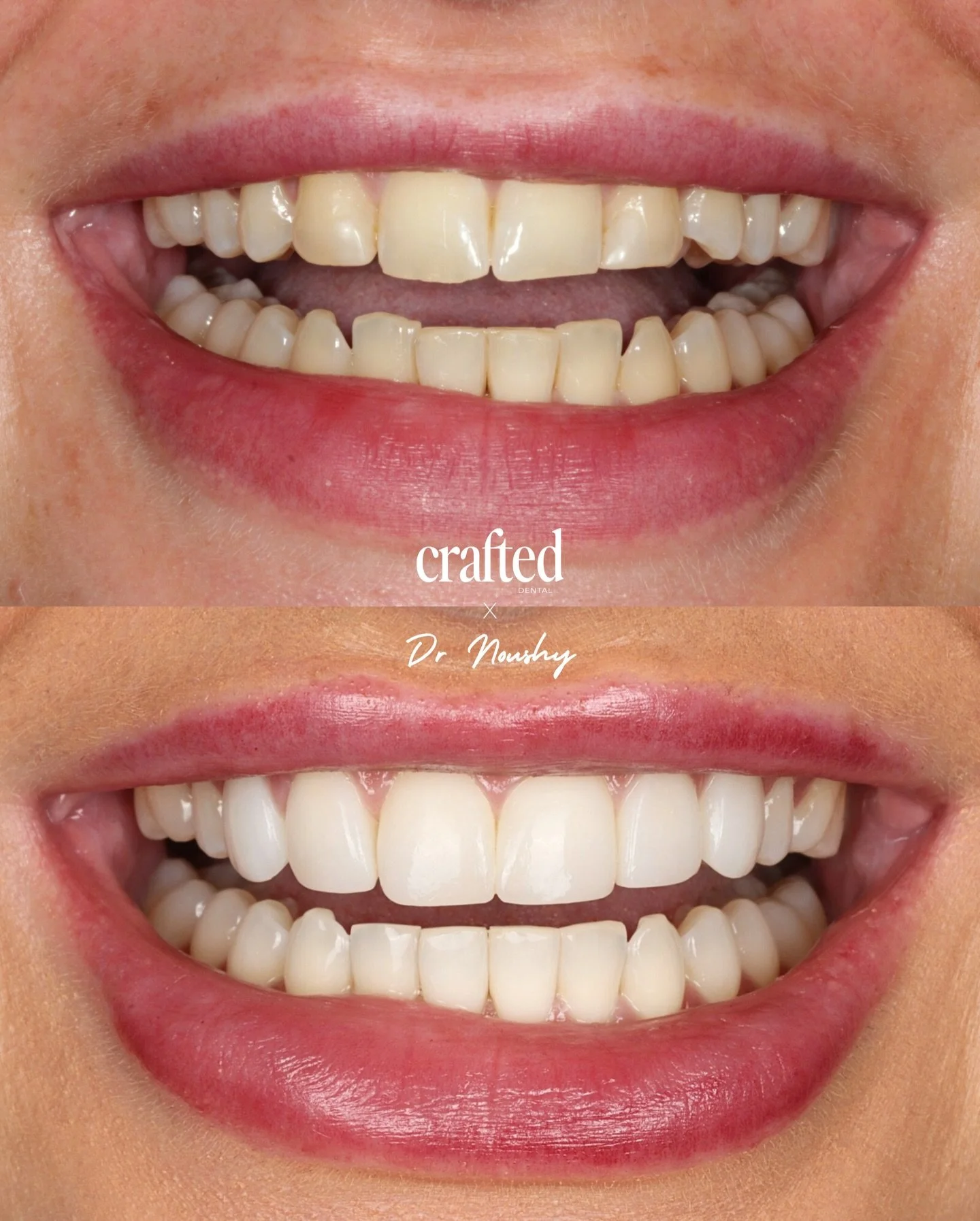 A smile crafted through true teamwork ✨

This patient came to us wanting brighter colour, more even shapes and improved symmetry. She&rsquo;d had braces in the past, but felt her lower teeth had moved. With a career that places her in front of people