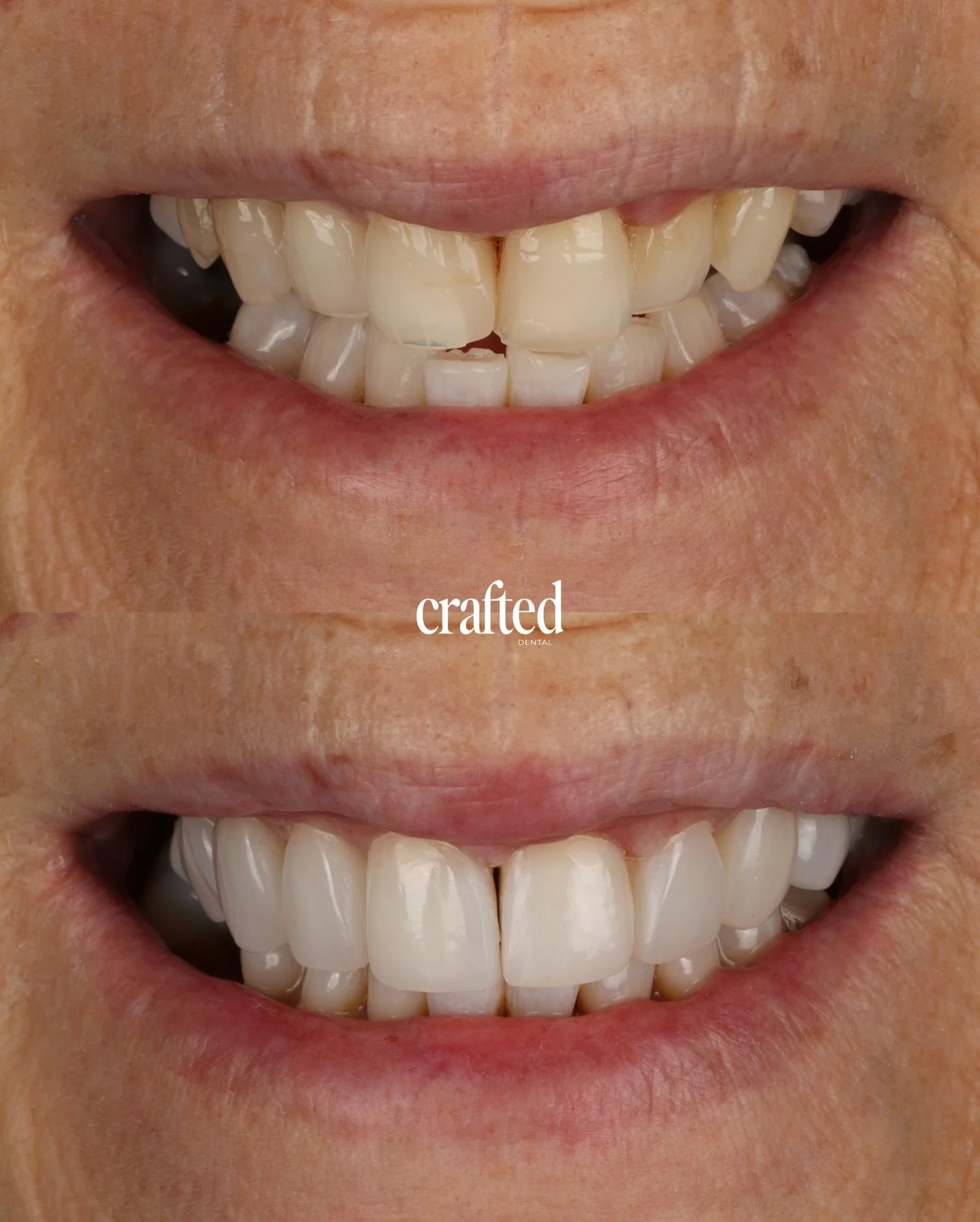 A beautifully refreshed and more harmonious smile ✨

This patient came to us wanting a brighter, straighter-looking and more symmetrical smile. She also had worn edges and older restorative work that no longer blended naturally with her teeth.

At Cr
