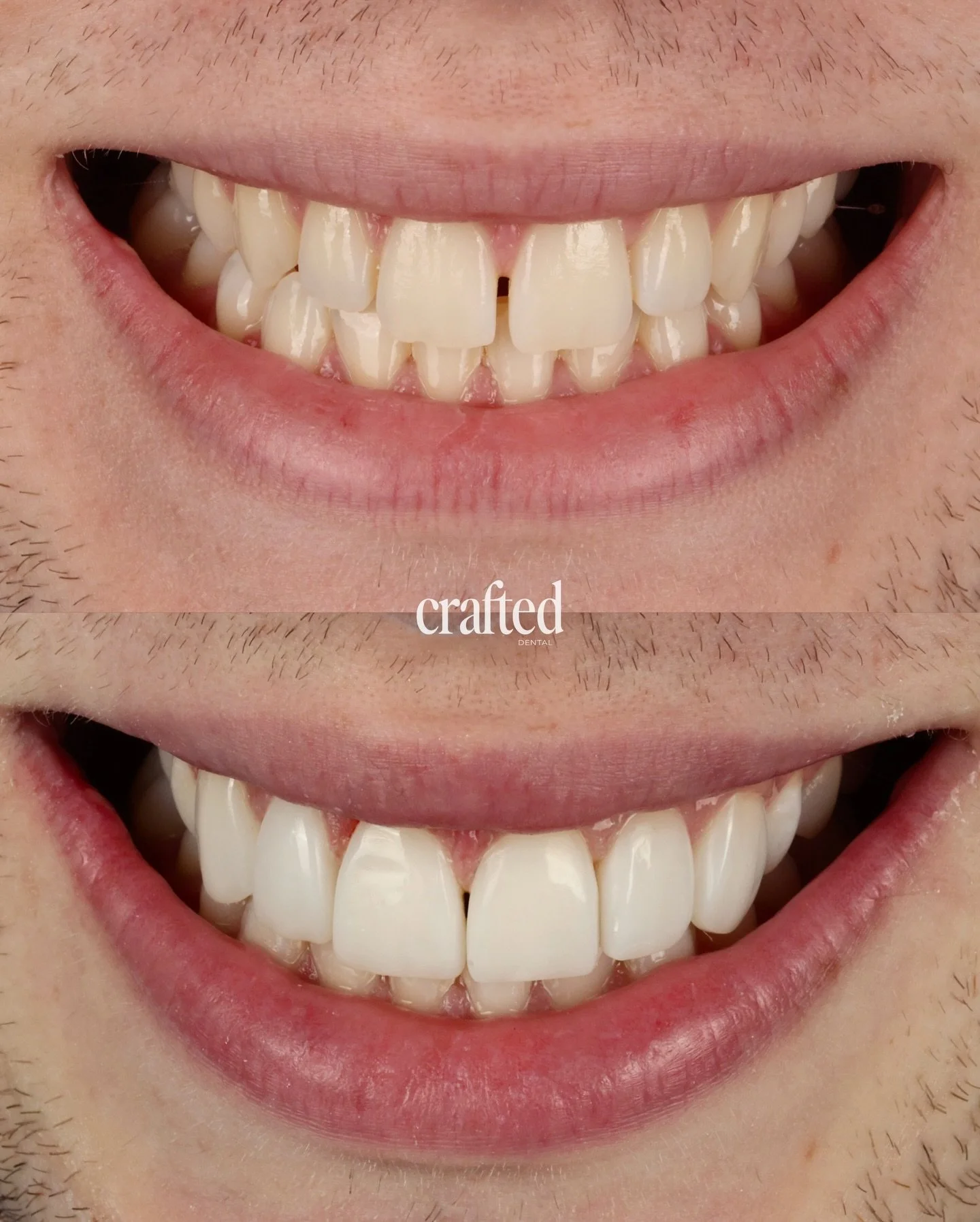 New Year, Same Results🫡

At Crafted Dental, we focused on enhancing what was already there for this patient. Keeping things minimal, natural, and tailored to them. 

The result is a brighter, more harmonious smile that still feels completely them ✨
