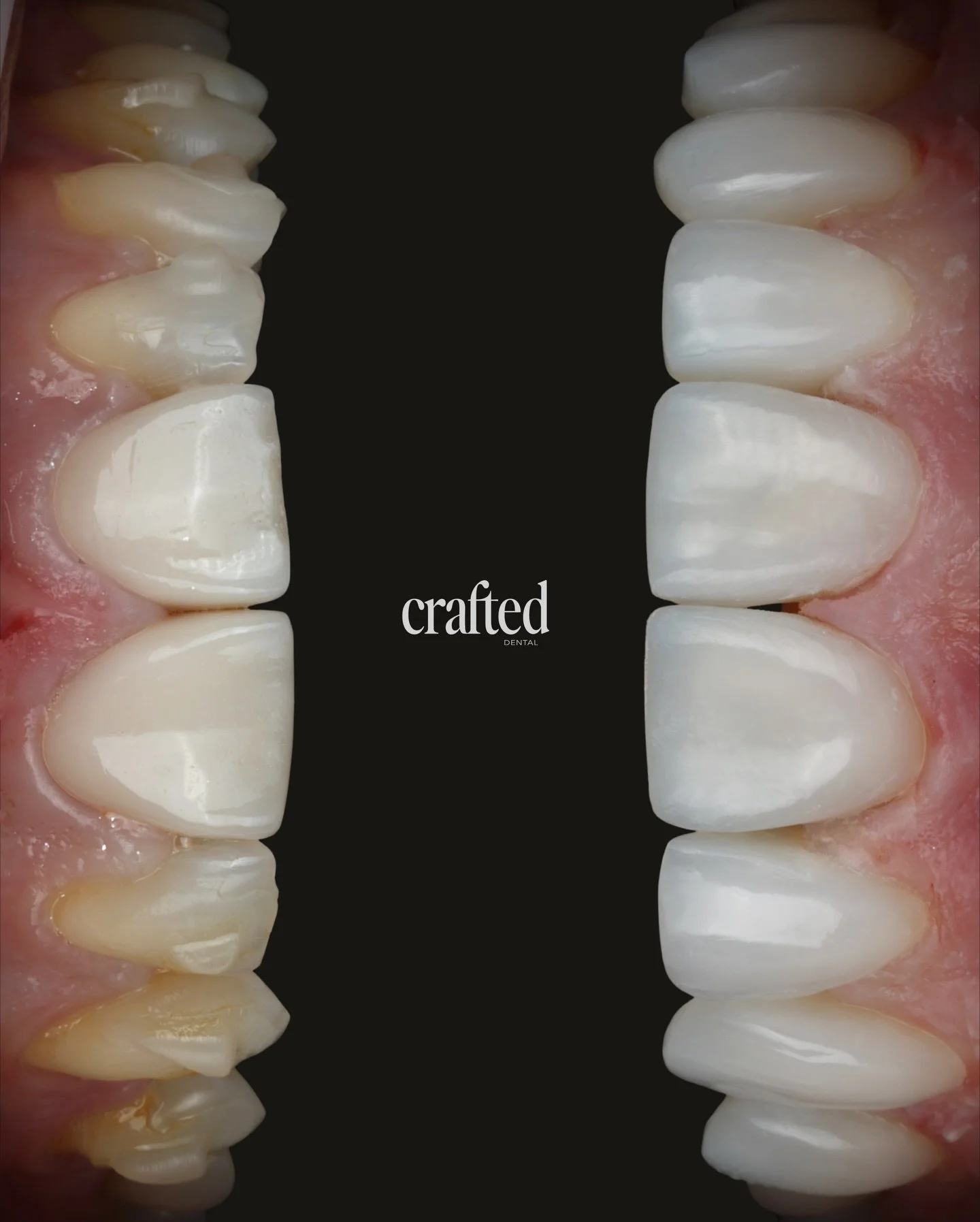 A smile transformation built step by step ✨

This patient&rsquo;s journey took place over 5 months of Invisalign, followed by 3 weeks of professional whitening and 8 composite bonding additions to refine the final result. Each stage was carefully pla