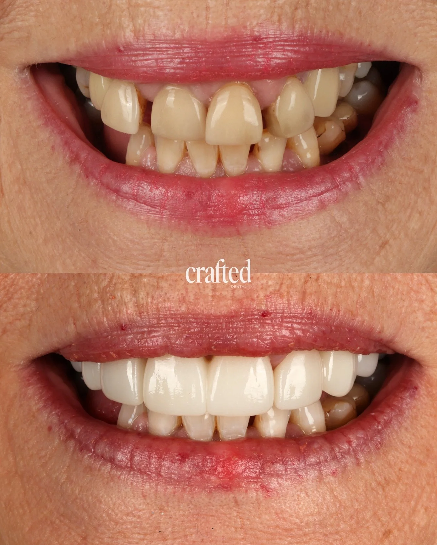CERAMIC BRIDGES: A January Smile Reset🦷🤎

At Crafted Dental, we focused on creating a smile that feels cohesive, natural, and truly her.

This patient came to us wanting to address gaps between her teeth, misalignment, and uneven colouring. She had