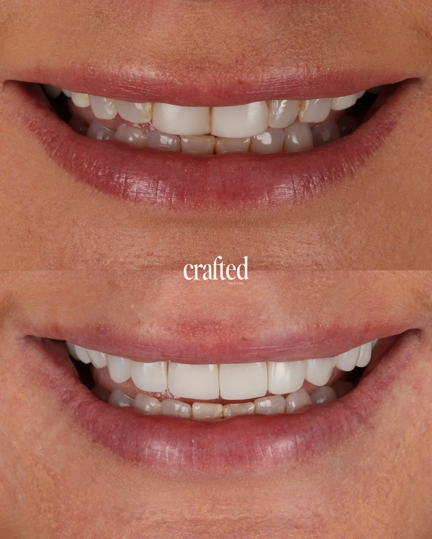 Sometimes it&rsquo;s not about doing more, it&rsquo;s about doing it right🤎

This patient came to us after having composite veneers completed elsewhere, but she still wasn&rsquo;t happy with her smile. The veneers lacked symmetry, didn&rsquo;t fully