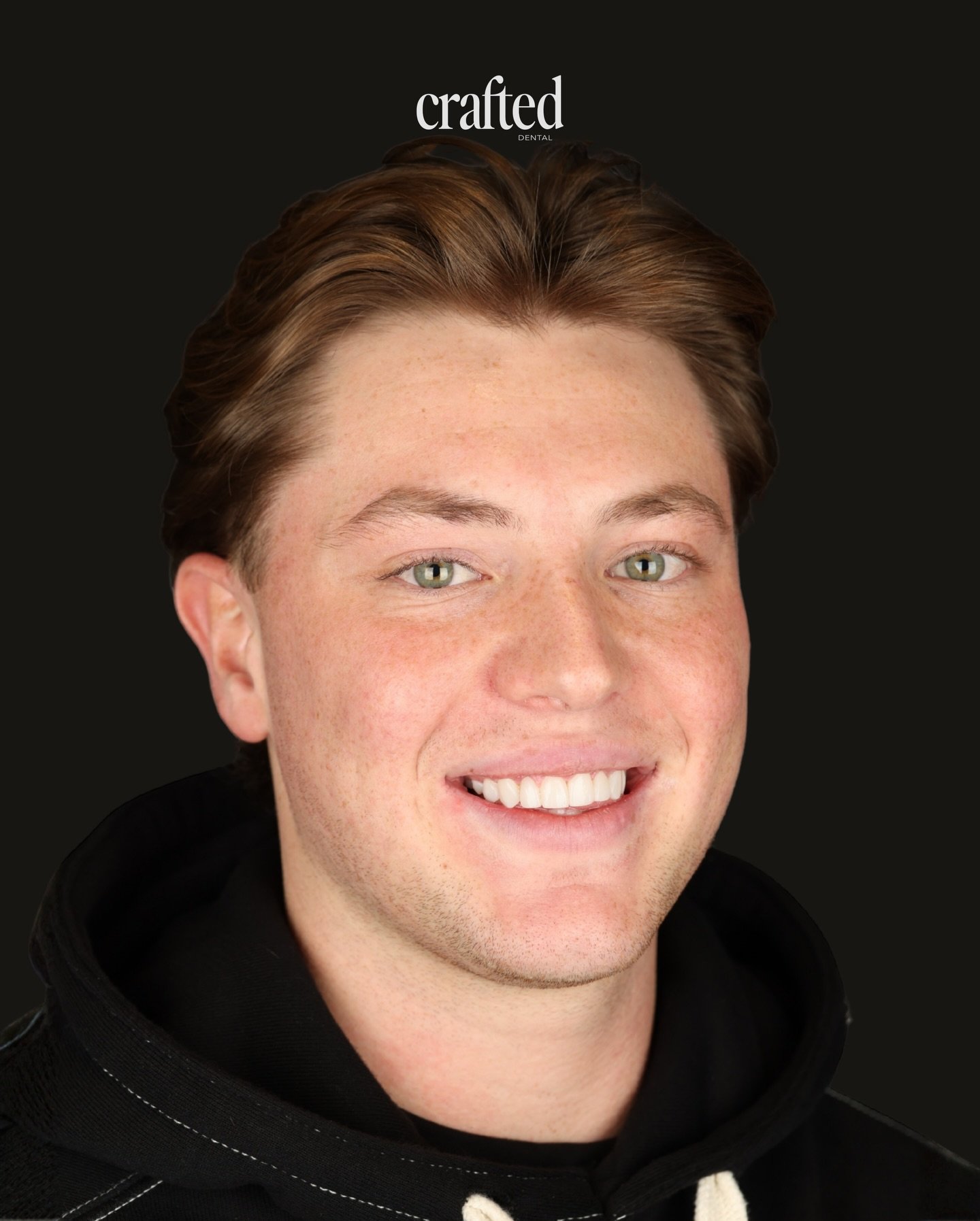 Hand Layered Composite Veneers = Perfection Every Time😮&zwj;💨❤️&zwj;🔥

This patient came to us wanting to address the short appearance of his teeth, worn edges, gaps, and an uneven gum line that showed more than he was comfortable with when smilin