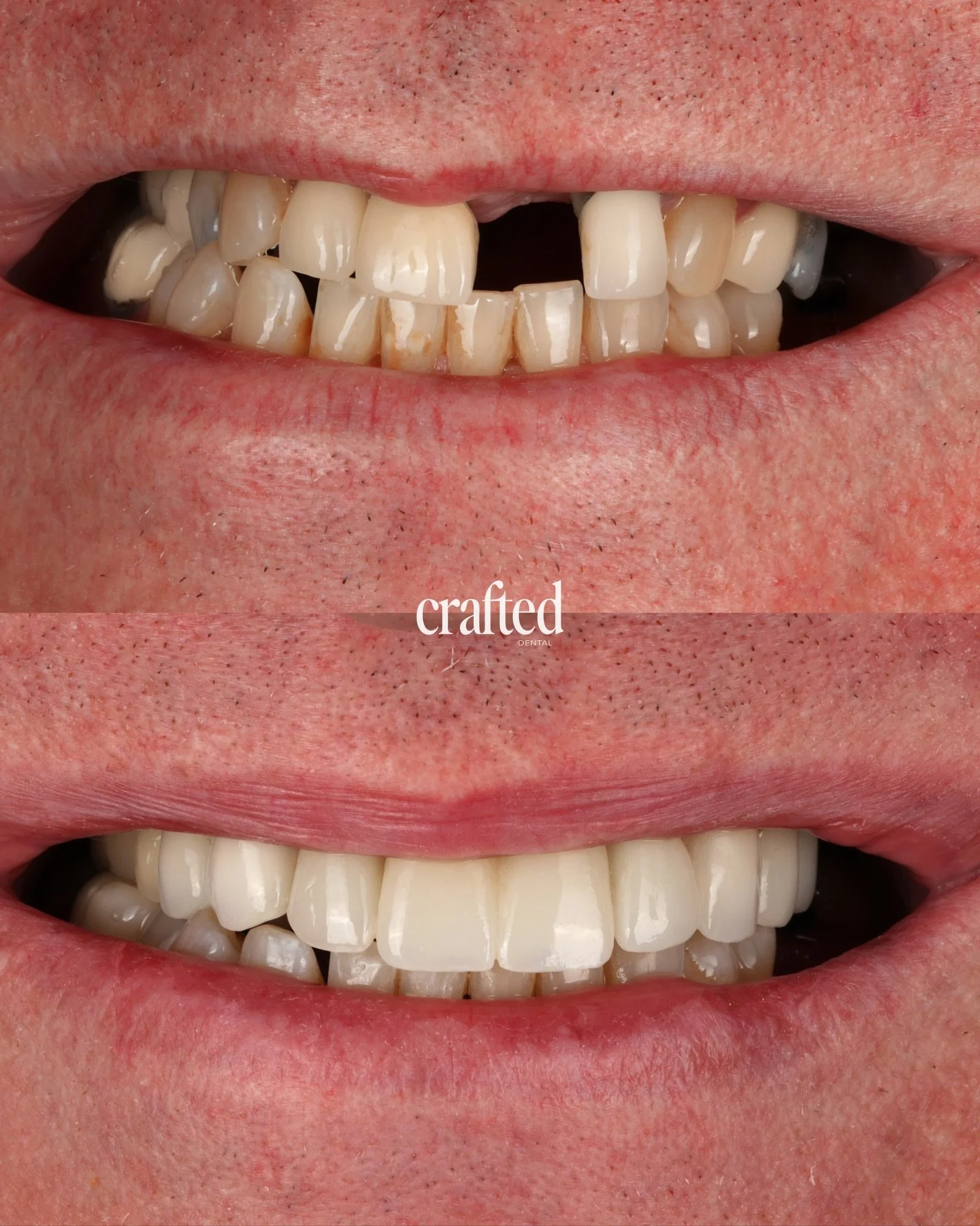 A smile transformation worth the journey🫶🏻

This patient came to us wanting to address a front tooth gap, uneven tooth shapes and shades, and older restorations that no longer blended with his smile. He was looking for a result that felt fuller, mo