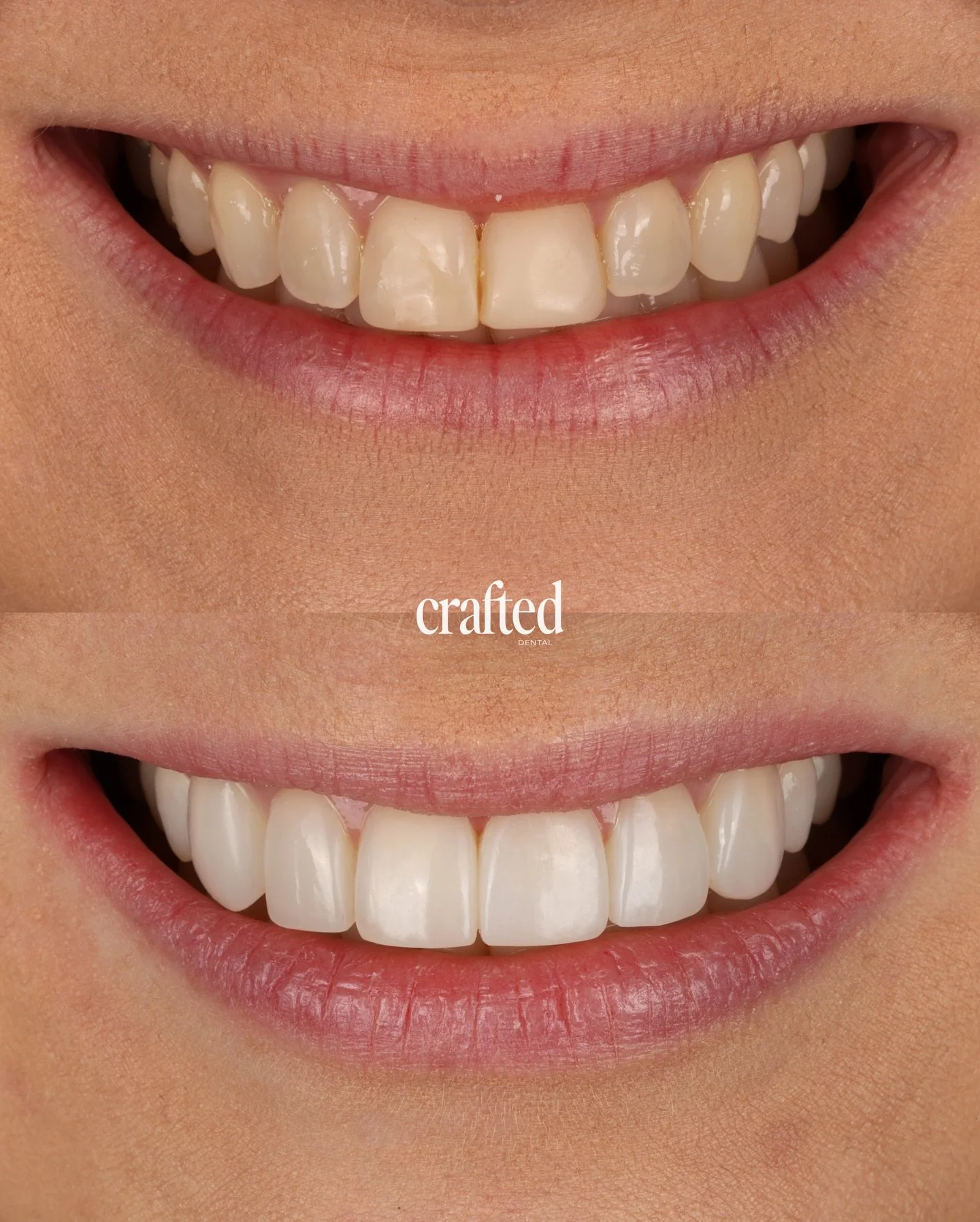 A refreshed smile with balance and harmony in mind🤎

This patient came to us unhappy with older composite bonding performed by her previous dentist on the front two teeth, feeling it no longer blended naturally with the rest of her smile. She wanted