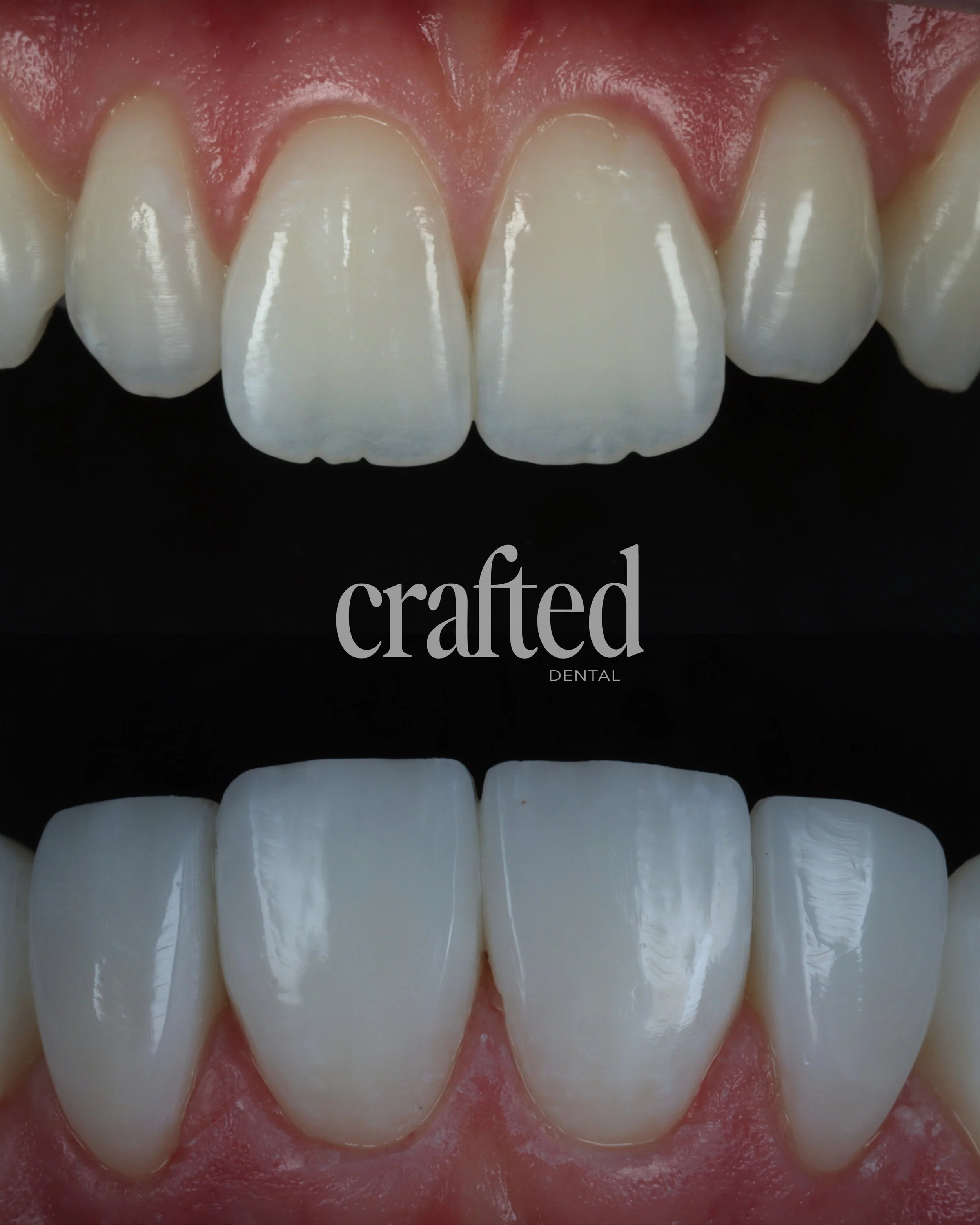 Close-up of teeth showing before and after dental composite bonding, with the before teeth appearing dull and uneven, and the after teeth appearing white, even, and polished.