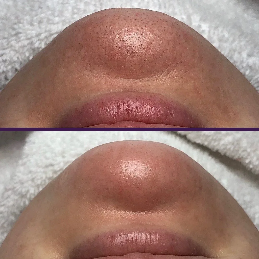 Before and after photo showing immediate results from HydraBrasion Pro treatment, performed on a client at Skinfinite Glow. Blackheads and clogged pores removed in same session, leading to dewy and glowing skin.