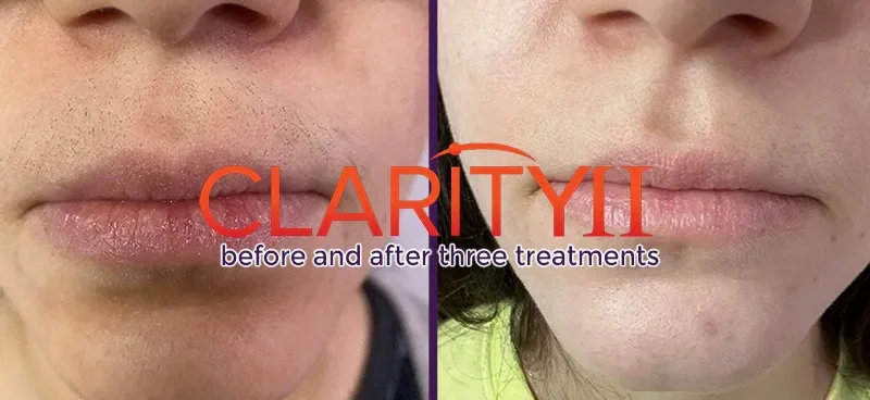 Side-by-side comparison of a woman's upper lip, showing hair removal using Clarity II laser in Calgary