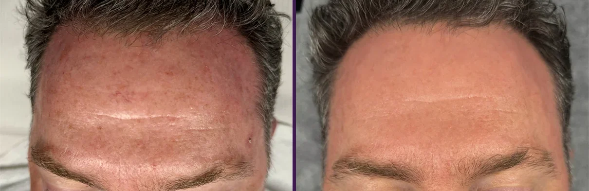 Comparison of a person's forehead before and after skin treatment, showing reduced redness and improved skin texture.