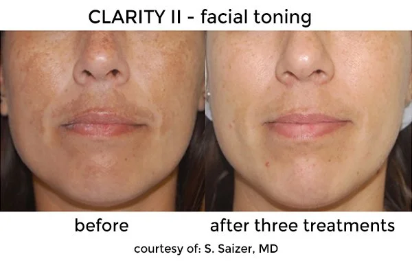 Side-by-side images showing a woman's face before and after three facial toning treatments, improving skin pigment uniformity, demonstrating improved skin appearance.
