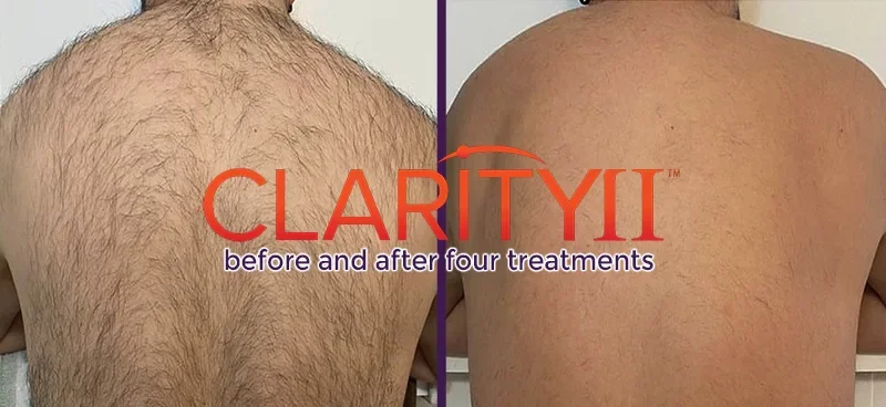 Side-by-side comparison of a man's back showing removal from laser before and after using Clarity II laser in Calgary