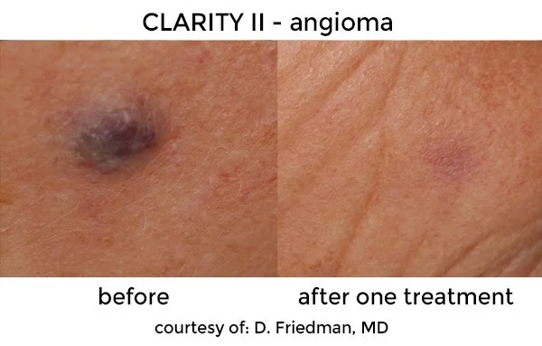 Close-up of skin showing a dark, raised skin lesion before treatment, and clear skin after one treatment for an angioma.