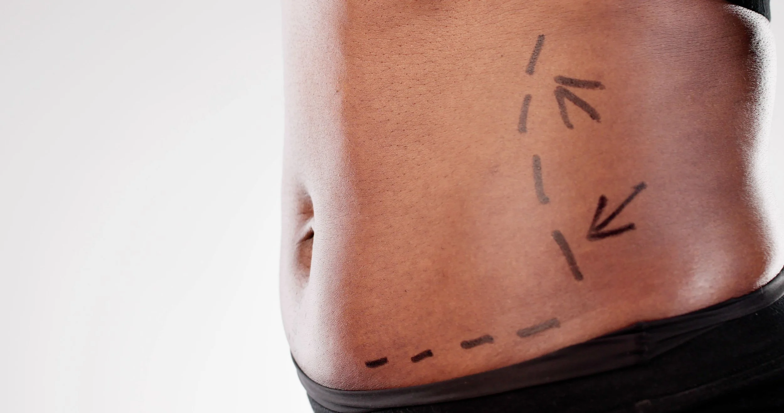 Close-up of a person's toned abdomen with black marker markings indicating a planned cosmetic procedure or surgery, against a neutral background.