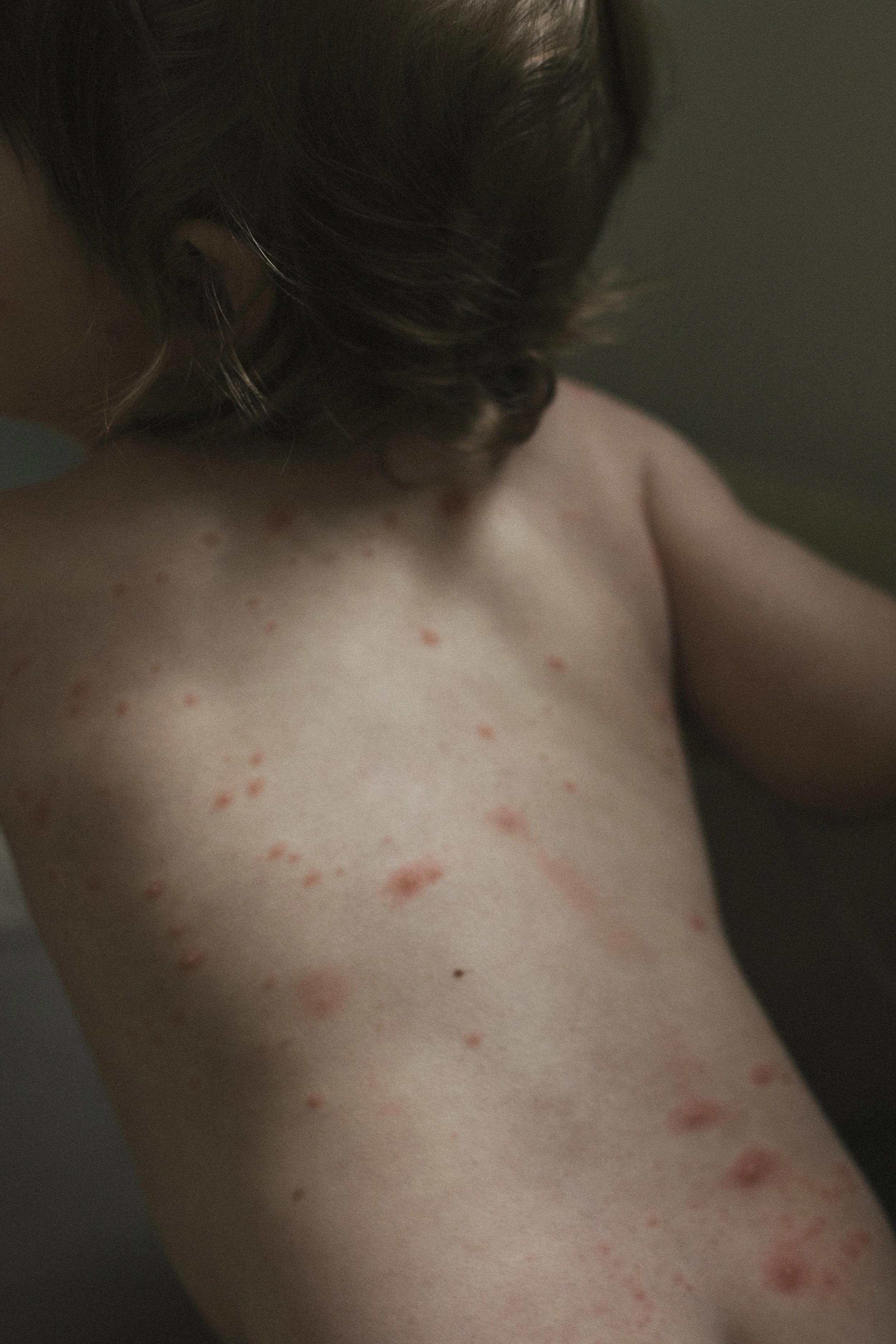 Chickenpox 
50X33CM 
Ed 5 + 1AP