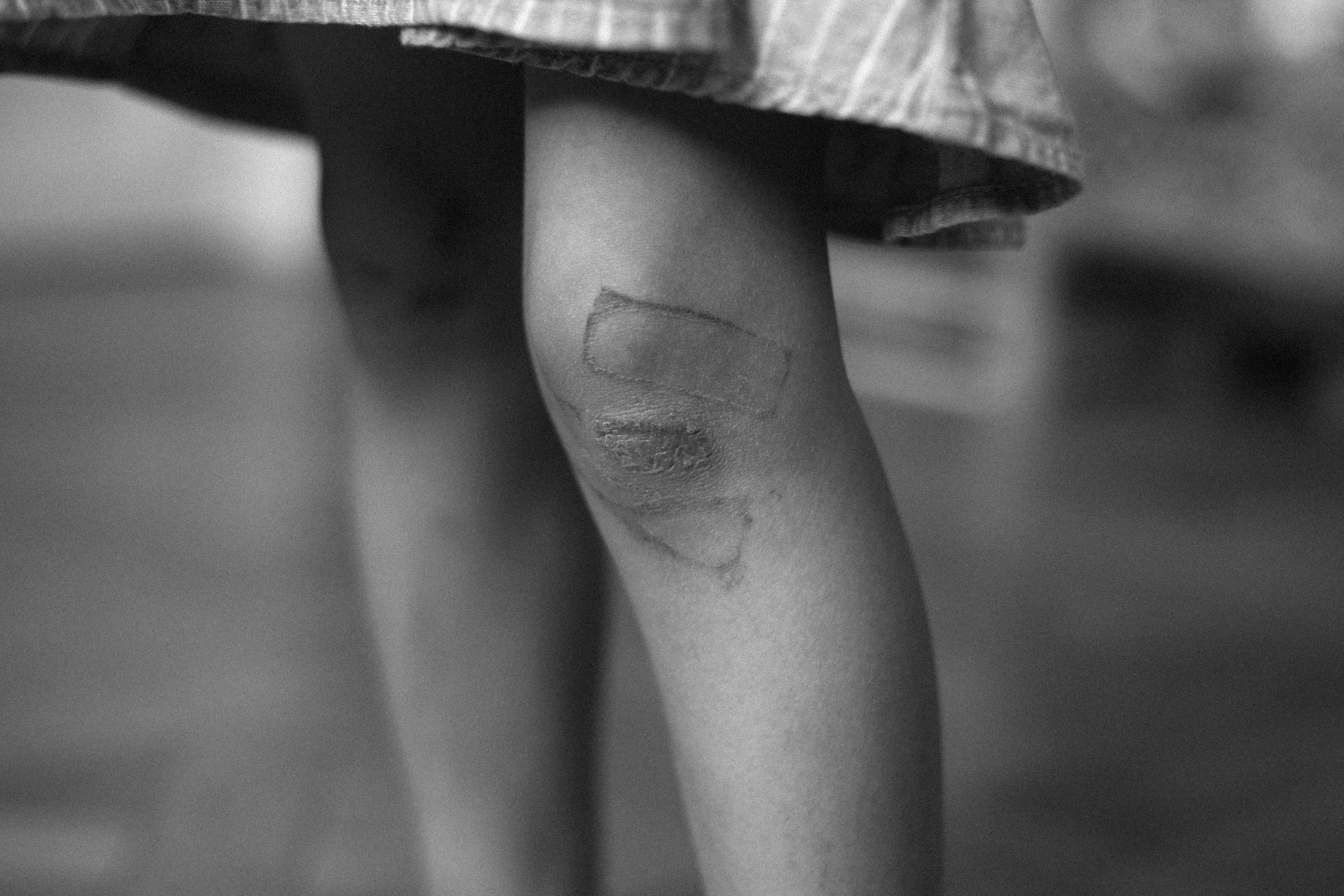 Scraped knee 
50X33CM
Ed 5 + 1AP