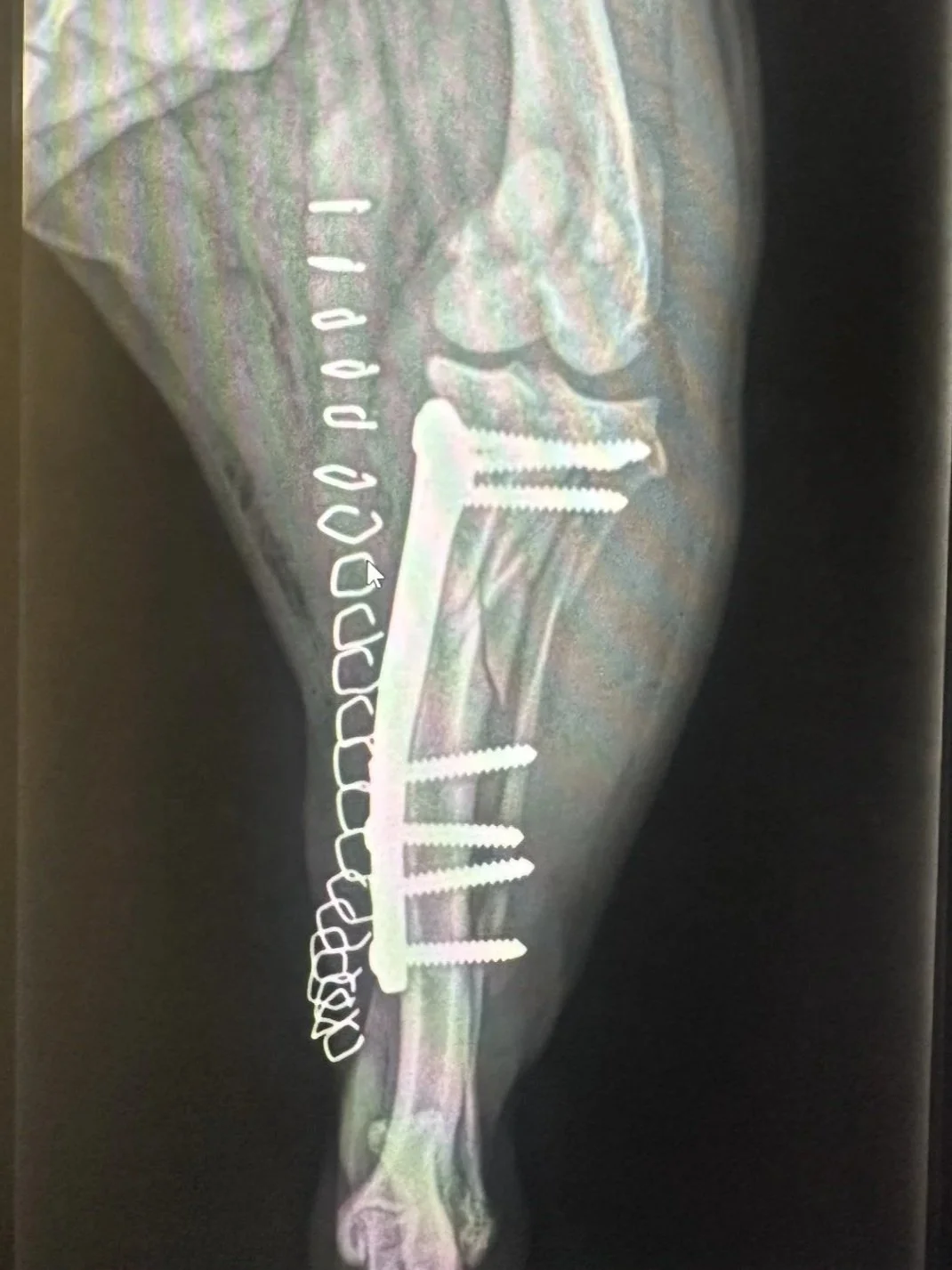 X-ray of a leg with metal screws and plates for orthopedic repair.