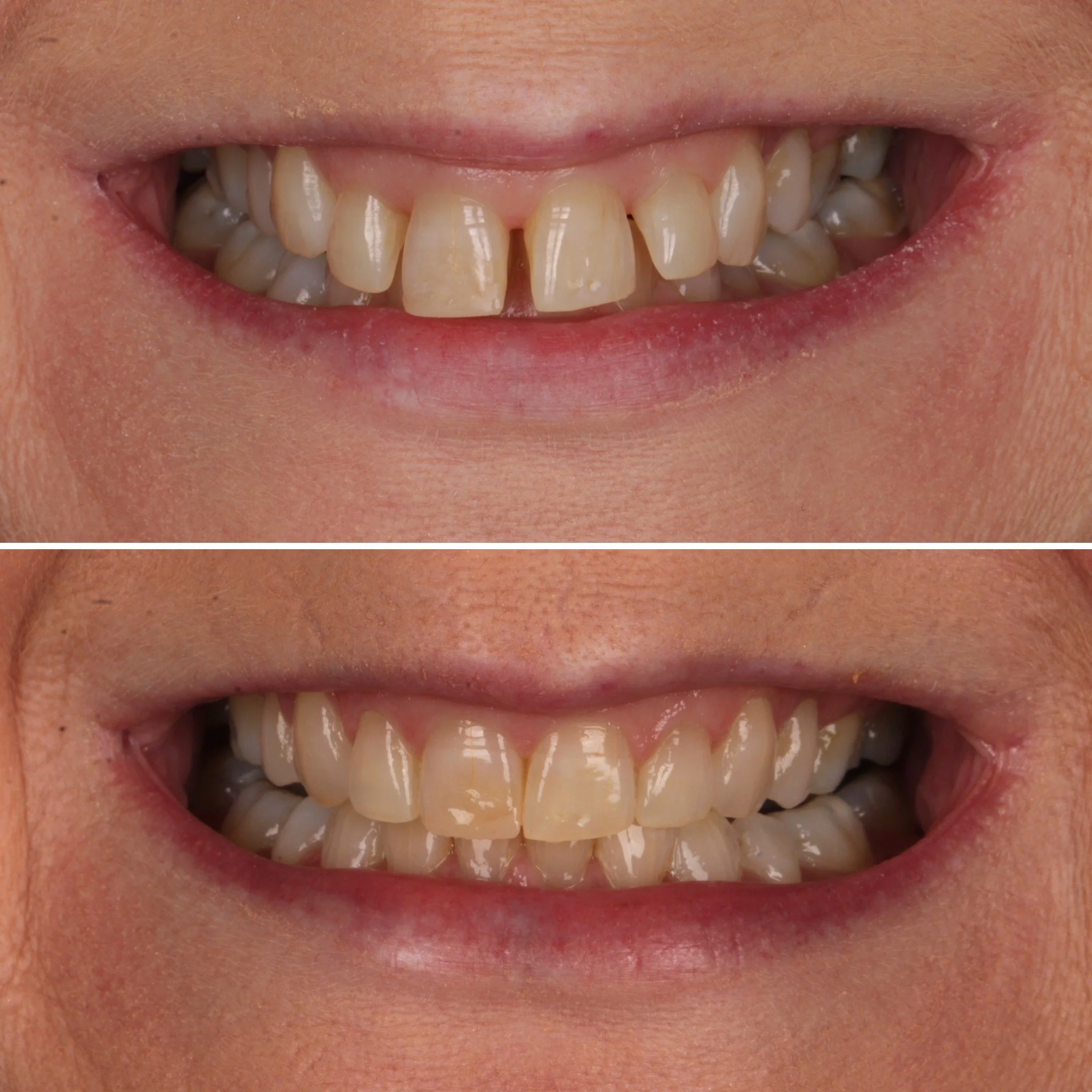 Close-up of a person's smile showing yellowed, uneven, and chipped teeth in two different views.