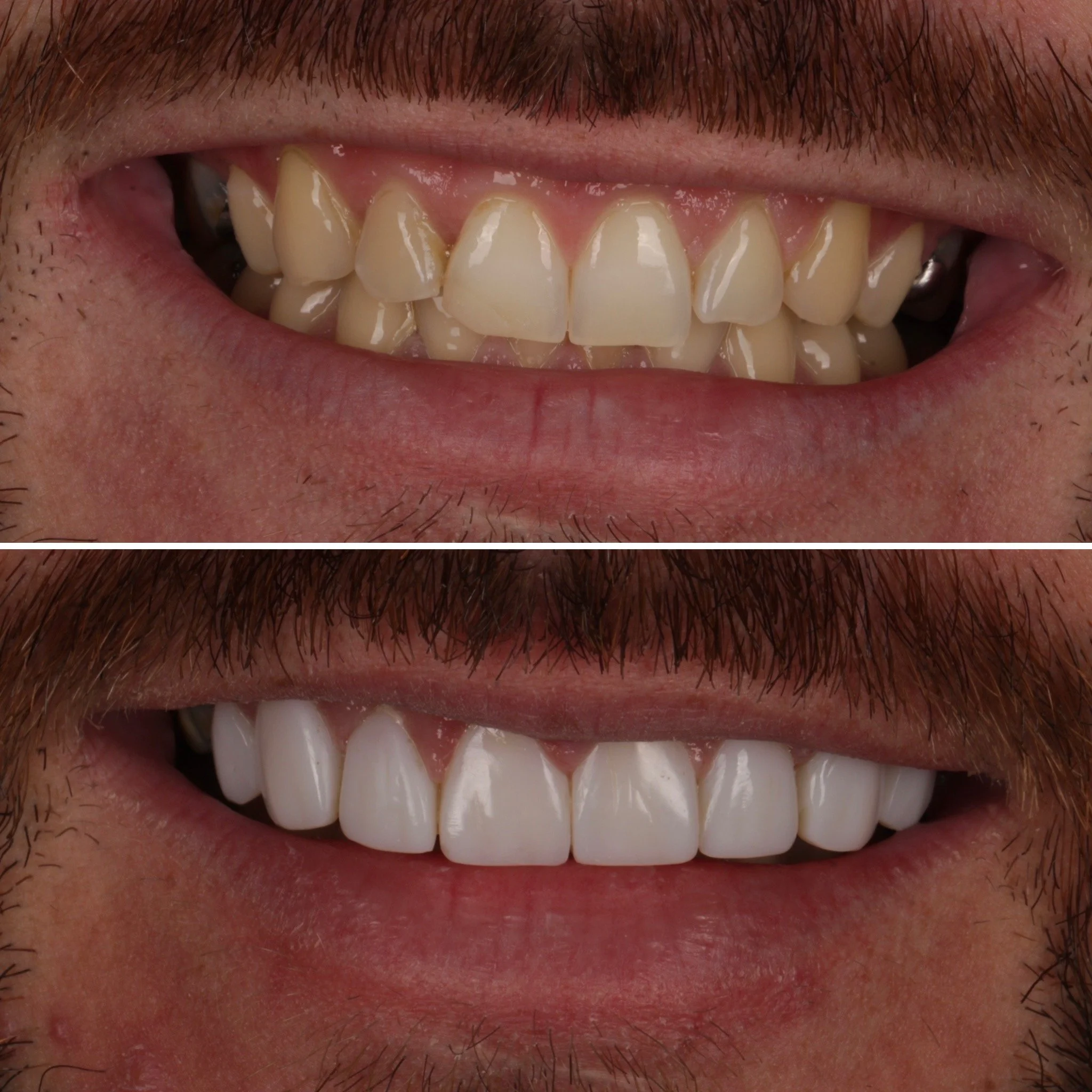 Comparison image showing a person's smile before and after teeth whitening, with visibly improved whiteness and alignment in the lower image.