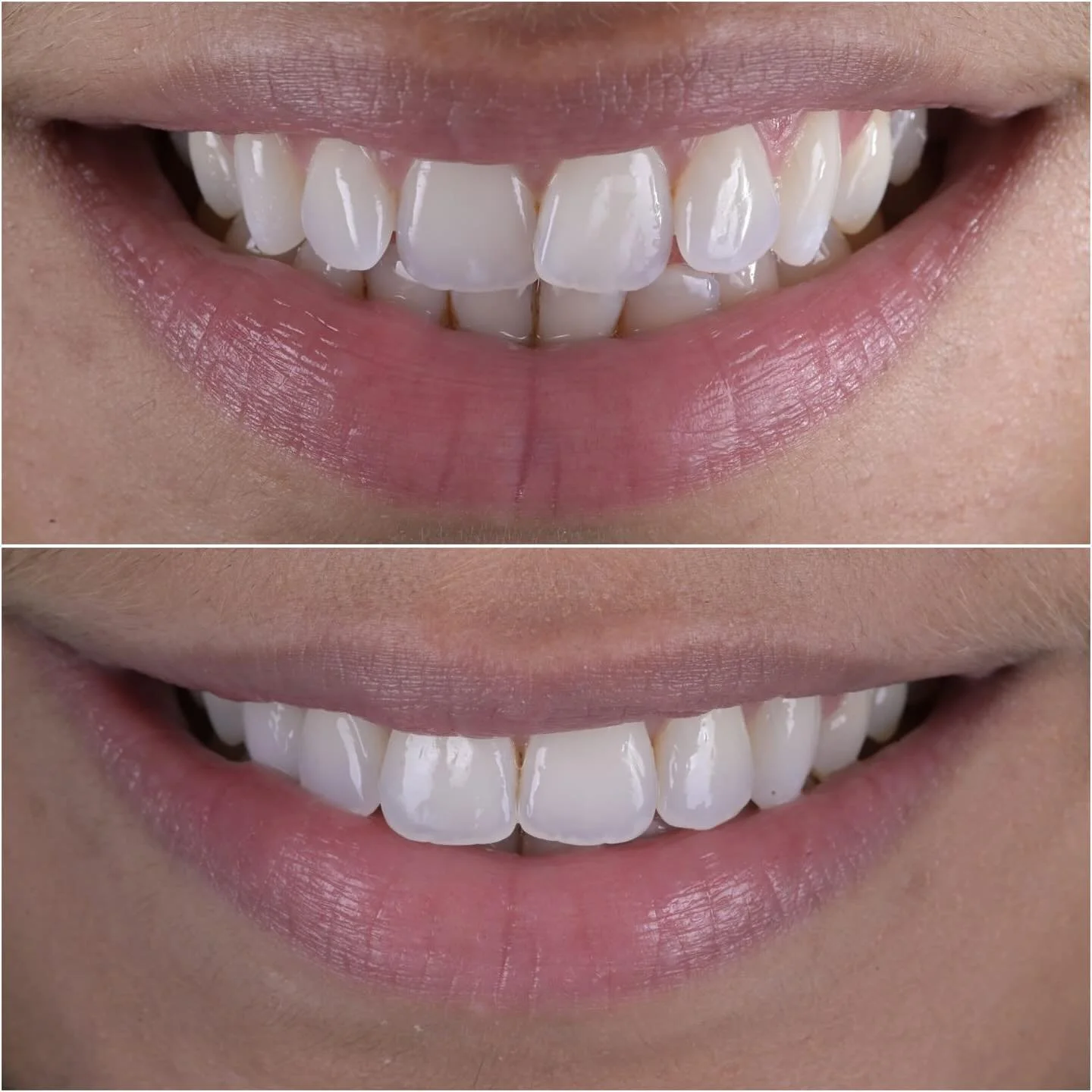Beautiful result using quick straight fixed braces, in just 5 months! 
@drkishmistry