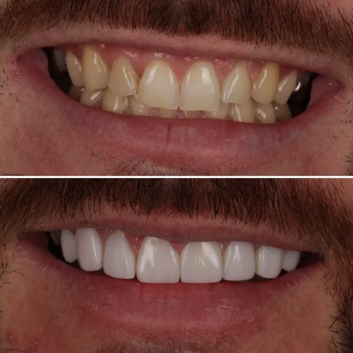 Composite bonding! Starts with a 30min consultation with @drliamwilson to carefully consider the result you want with the composite materials and techniques available &hellip; and the result speaks for itself! 
☎️01617476841 
📧 info@calmdentalcare.c