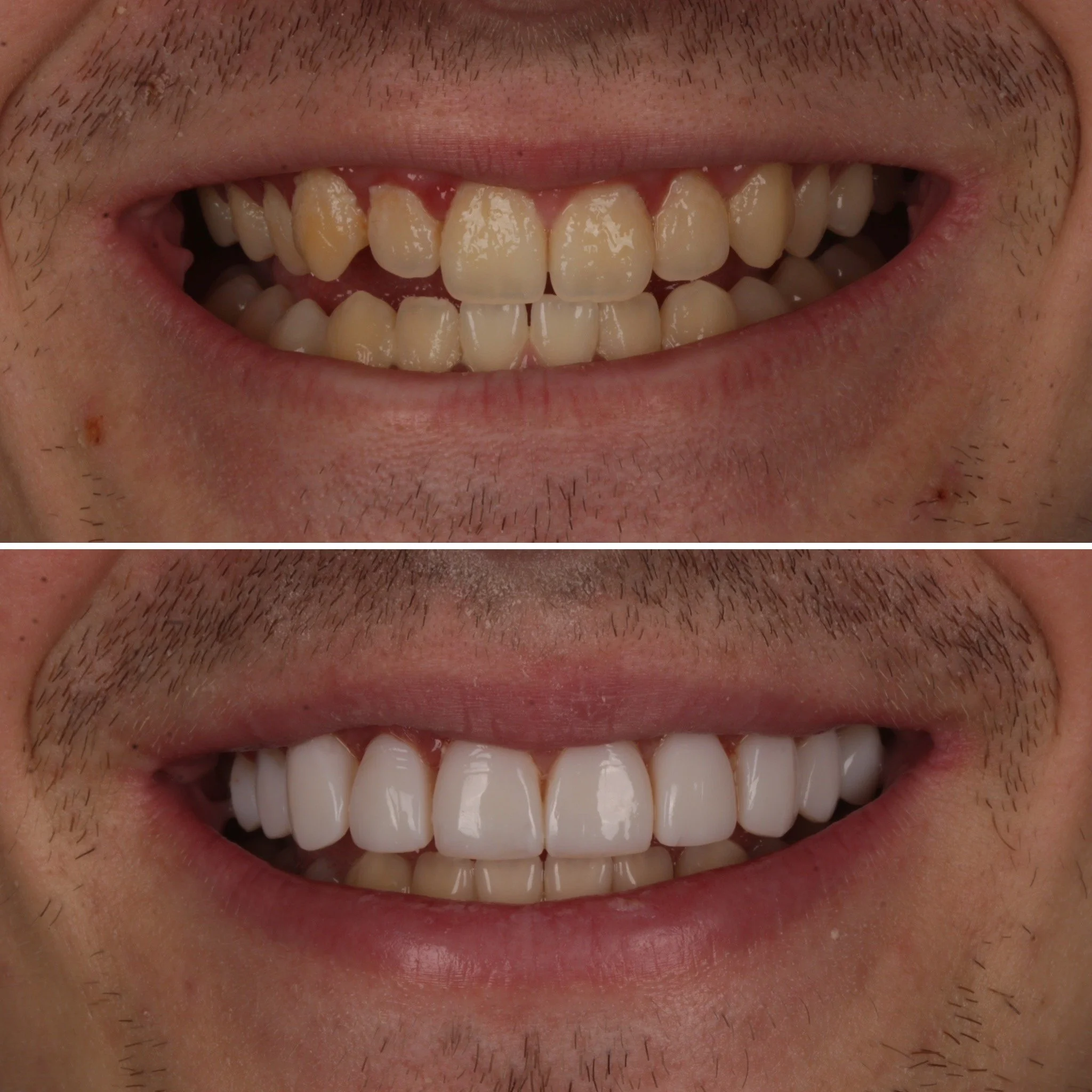 Comparison of a person's teeth before and after dental whitening, showing a significant improvement in color and appearance.