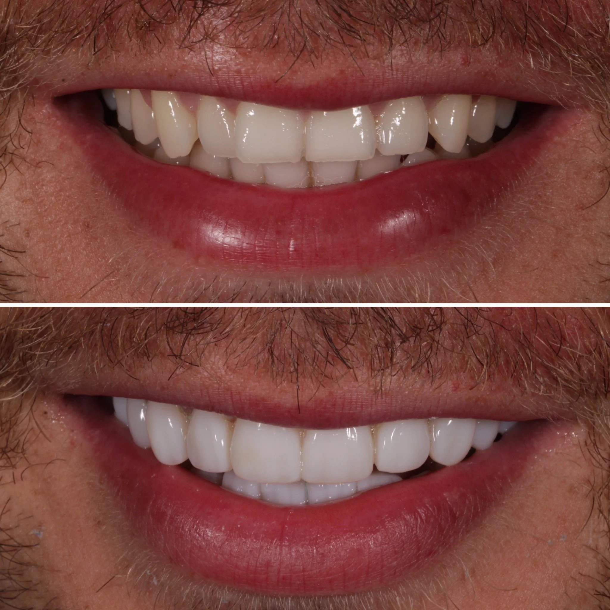 Comparison of a person's teeth before and after dental treatment; top image shows stained, uneven teeth, bottom image shows cleaner, whiter, and more even teeth.