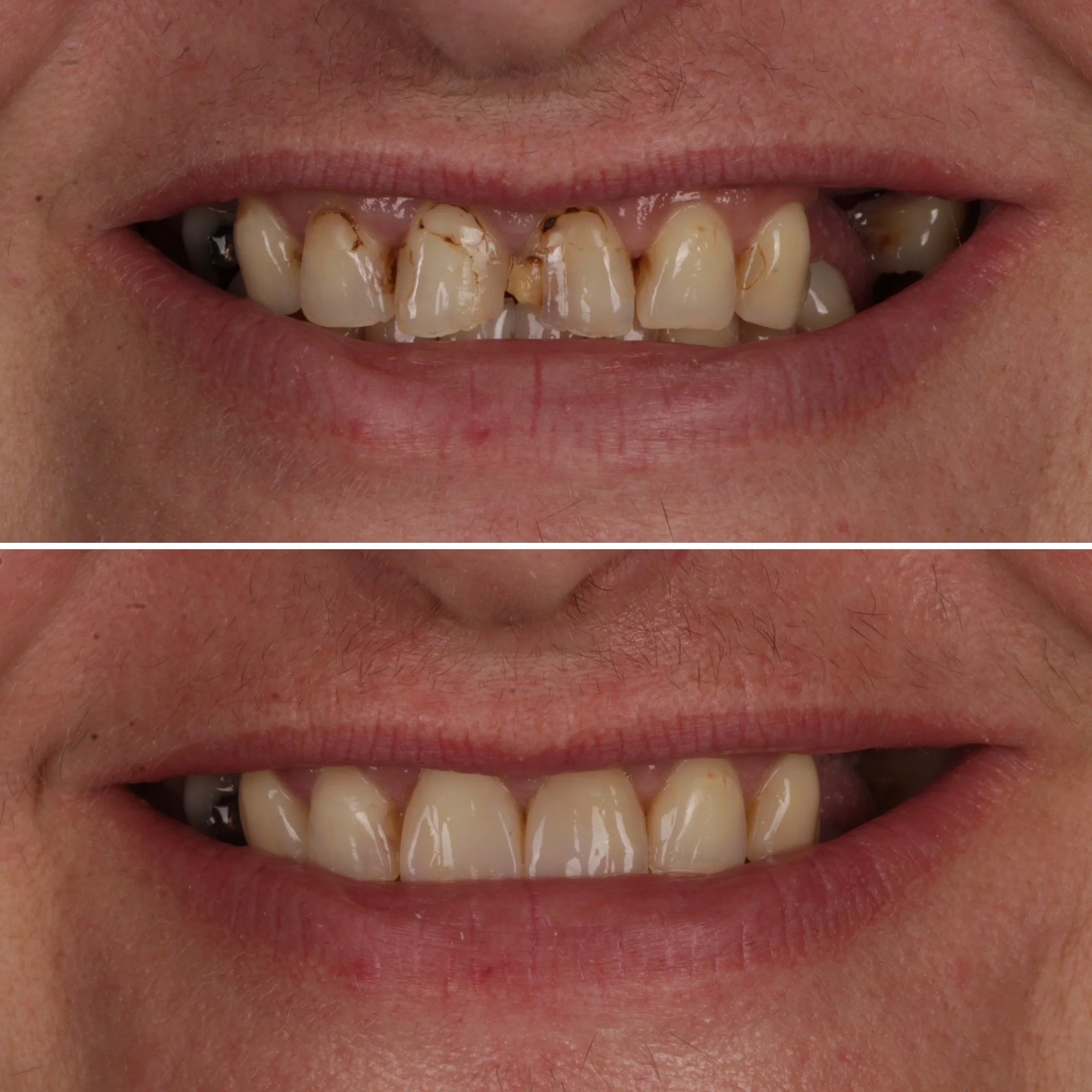 Before and after images of teeth whitening, showing significant improvement in dental appearance.