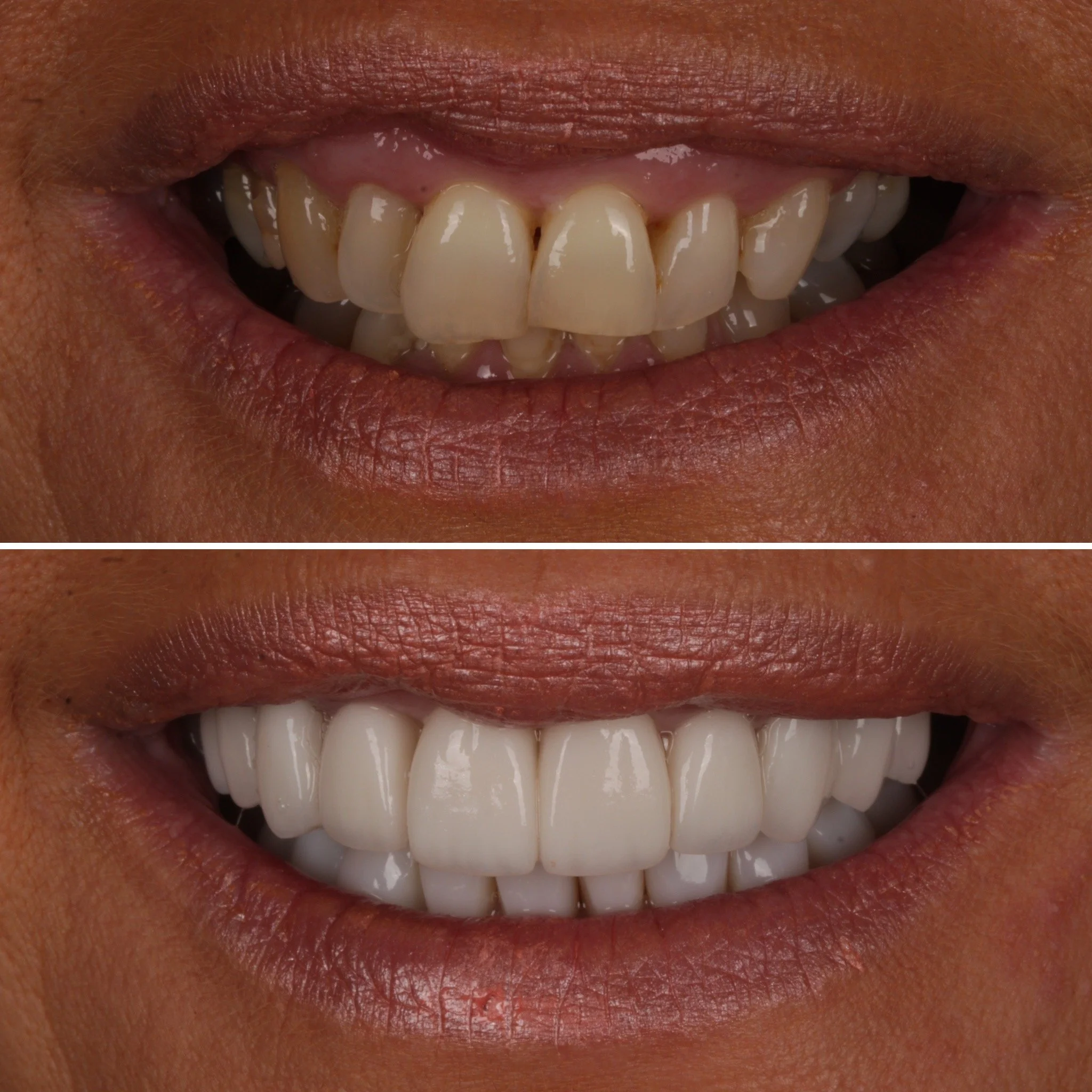 Comparison of teeth before and after dental whitening, showing a person’s smile with improved, whiter teeth in the bottom image.