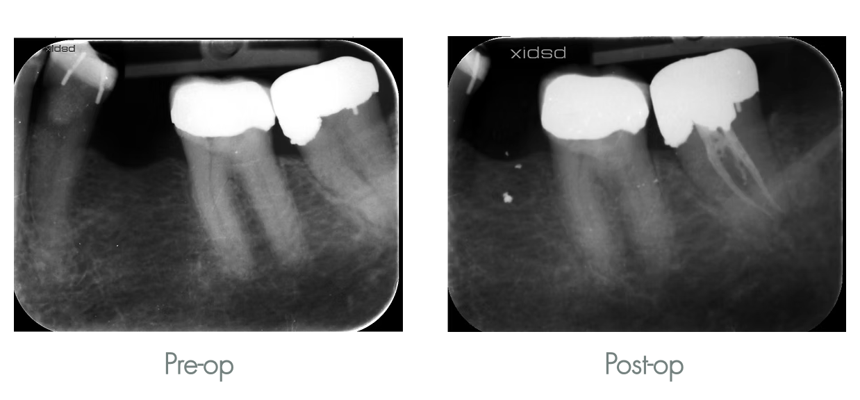 X-ray images showing a dental procedure before and after root canal treatment on two adjacent teeth with dental fillings.