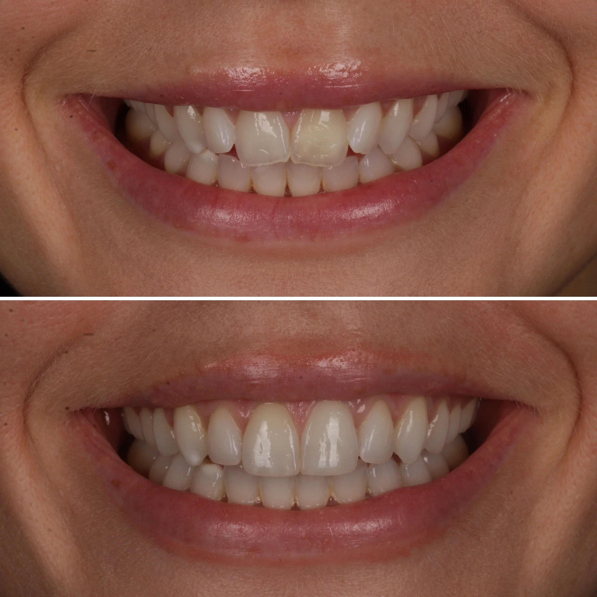 Close-up of a person's smile showing teeth before and after teeth whitening procedure.