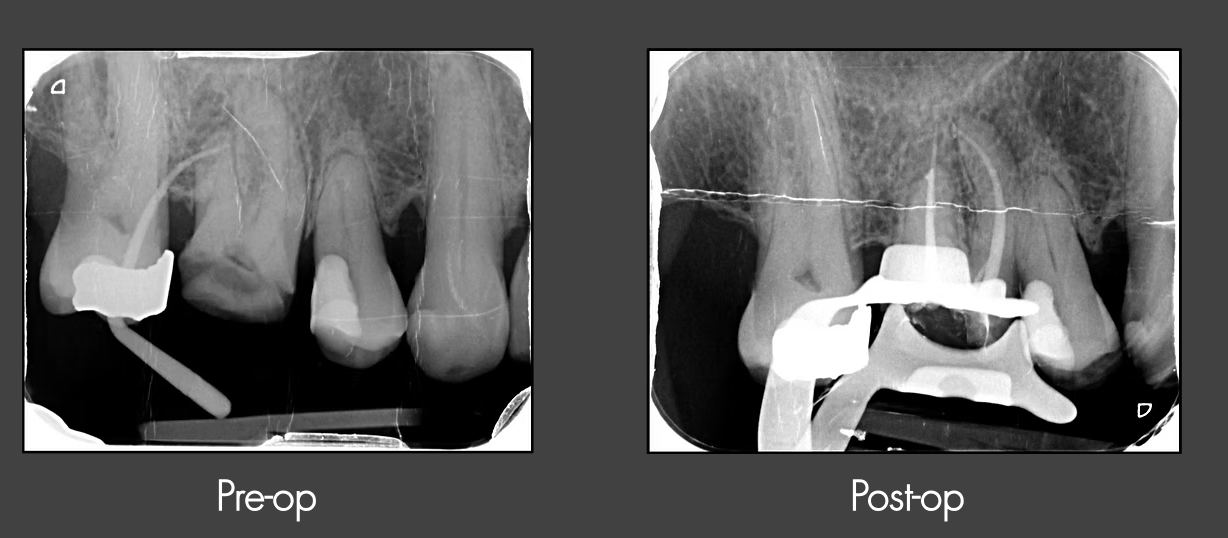 X-ray images showing teeth before and after dental procedures, with dental hardware visible in both the pre-operative and post-operative images.