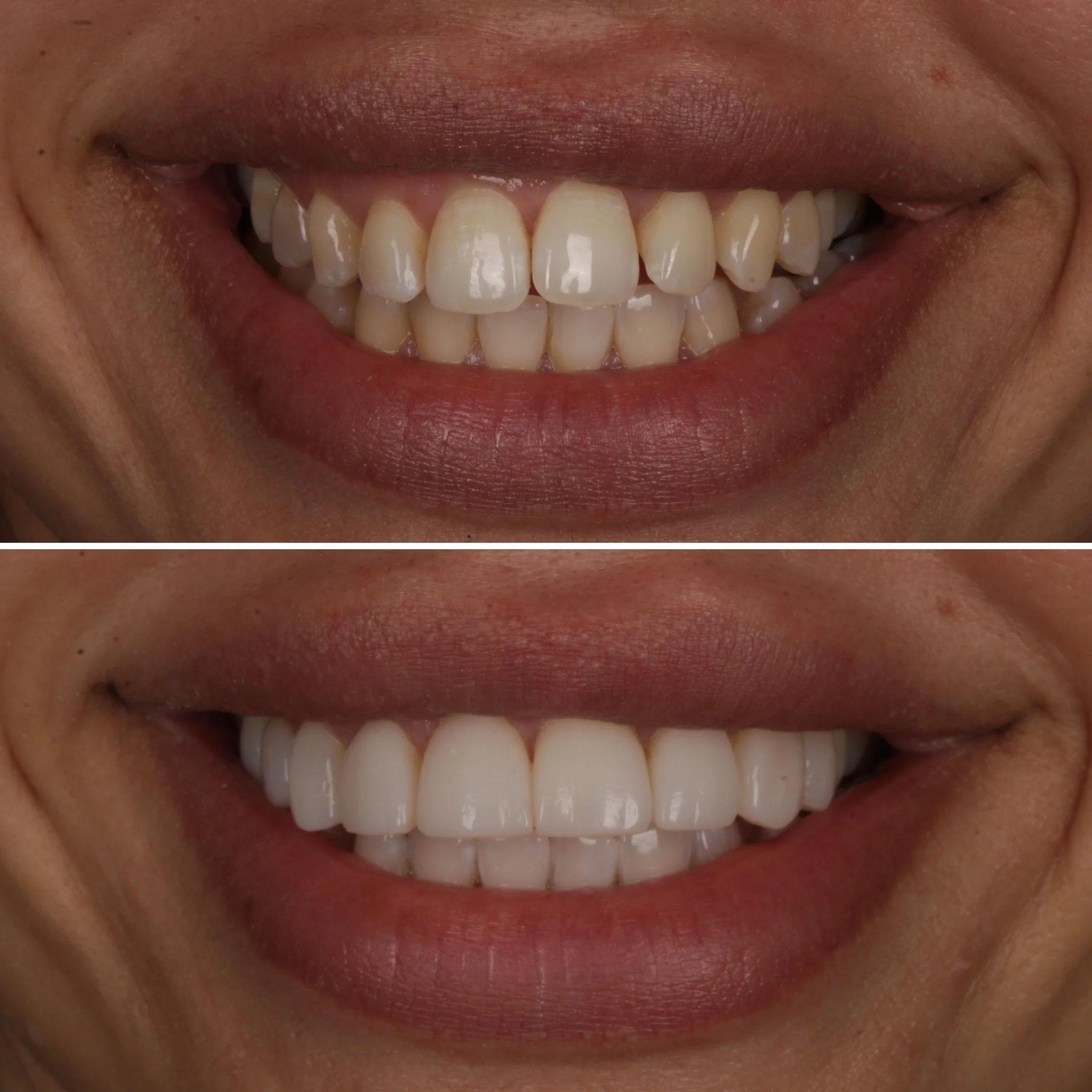 Close-up comparison of a person's smile before and after teeth whitening. The top image shows discolored and uneven teeth, while the bottom image shows brighter, whiter teeth.