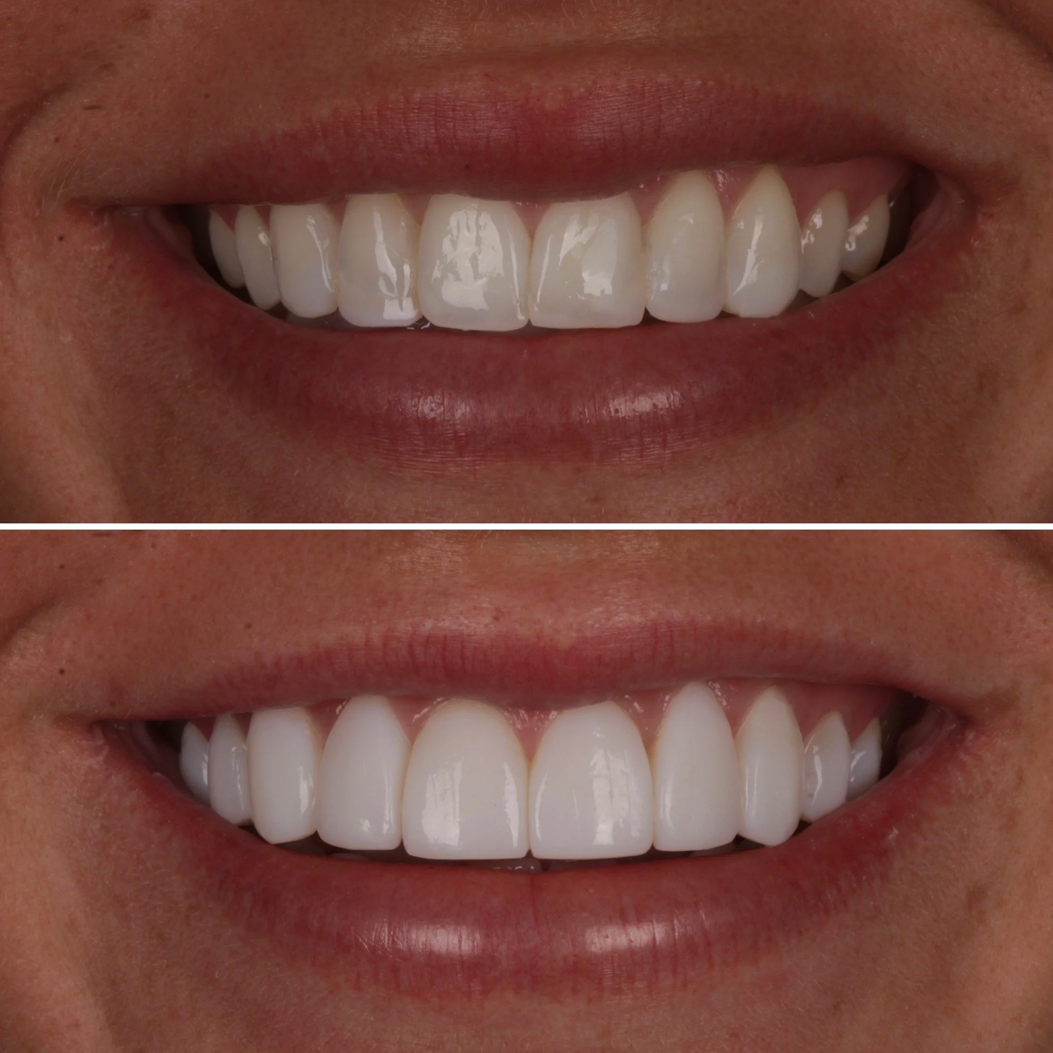 Close-up of a person's smiling mouth showing white, straight teeth before and after teeth whitening treatment.