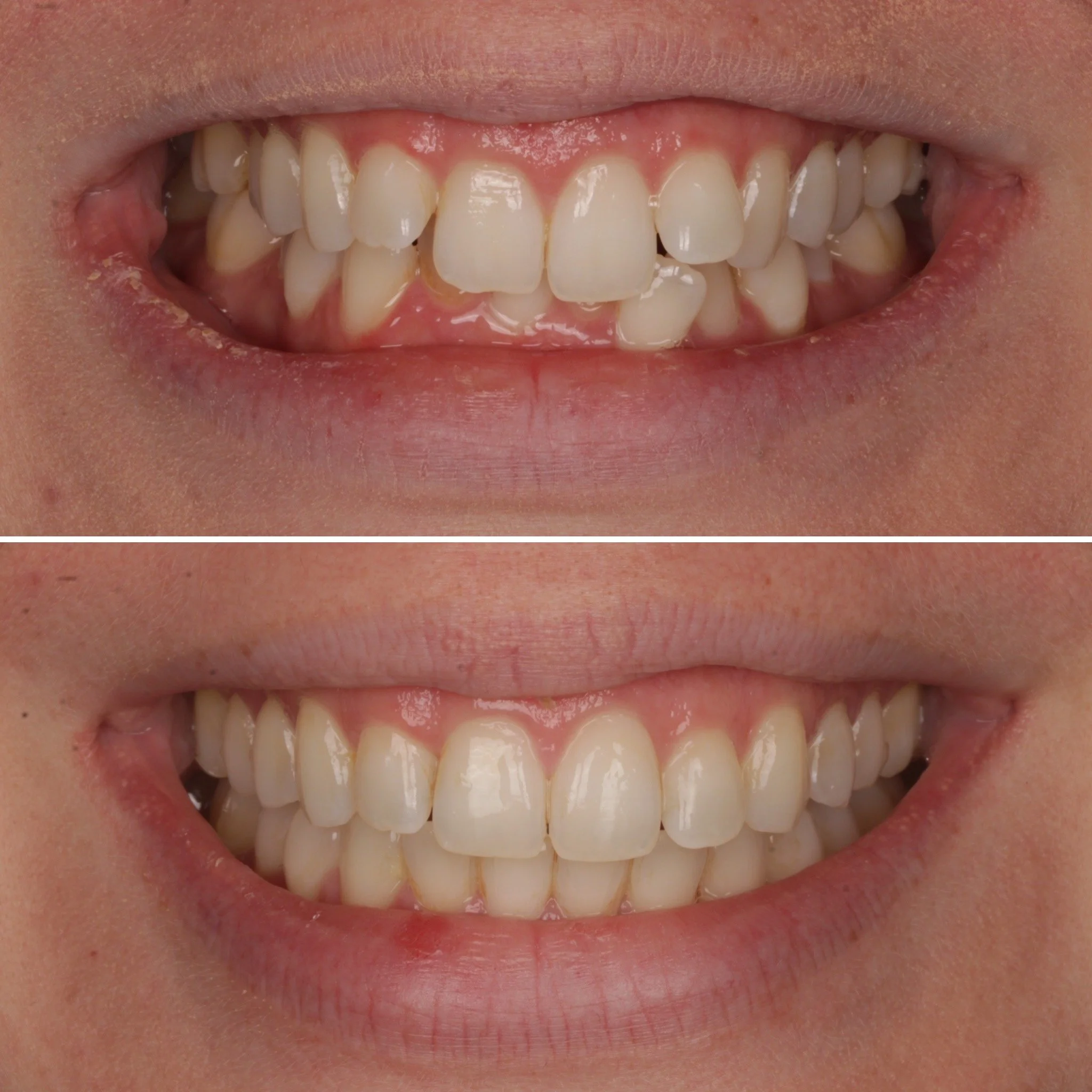 Close-up of a person's smile showing their teeth before and after dental treatment, with straighter teeth in the after image.