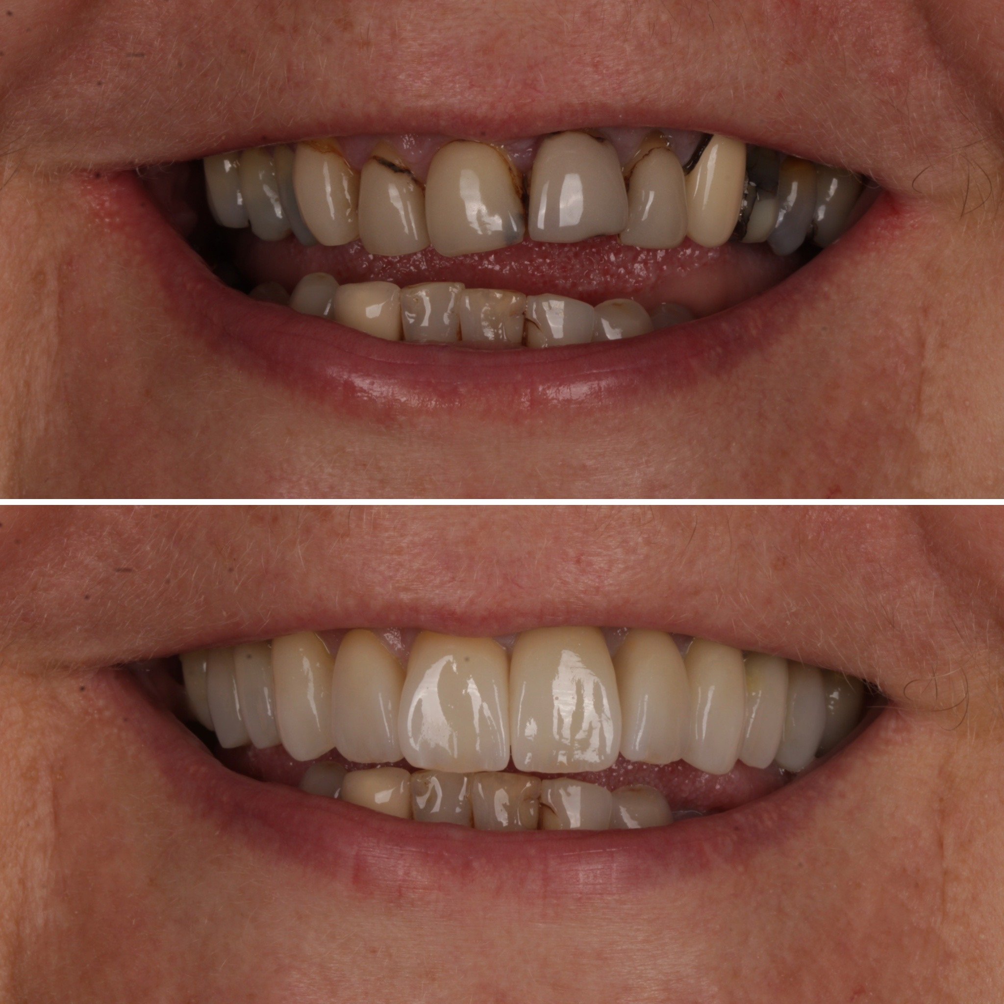 Before and after images of teeth whitening and dental restoration.