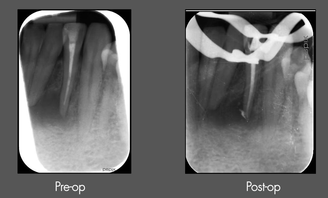 Dental X-rays showing root canal treatment, with a clear comparison between pre-operation and post-operation images.