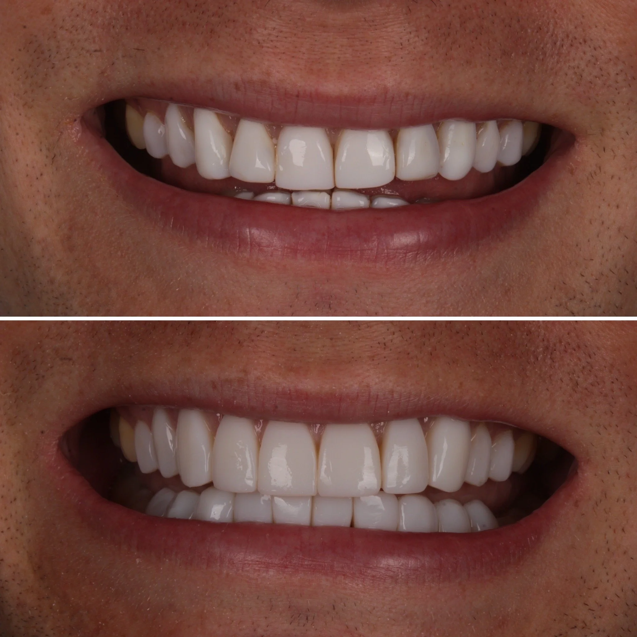 Close-up of a person's smile showing before and after teeth whitening, with noticeably whiter teeth in the bottom image.
