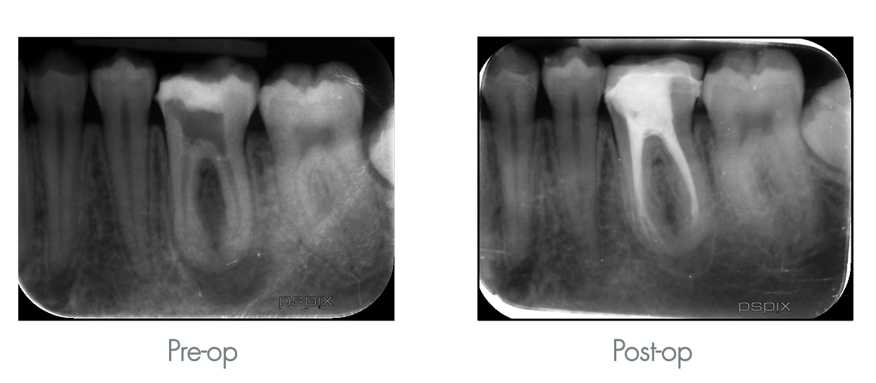 X-ray images showing a tooth before and after root canal treatment, with the post-op image showing a cleaned and filled root canal.