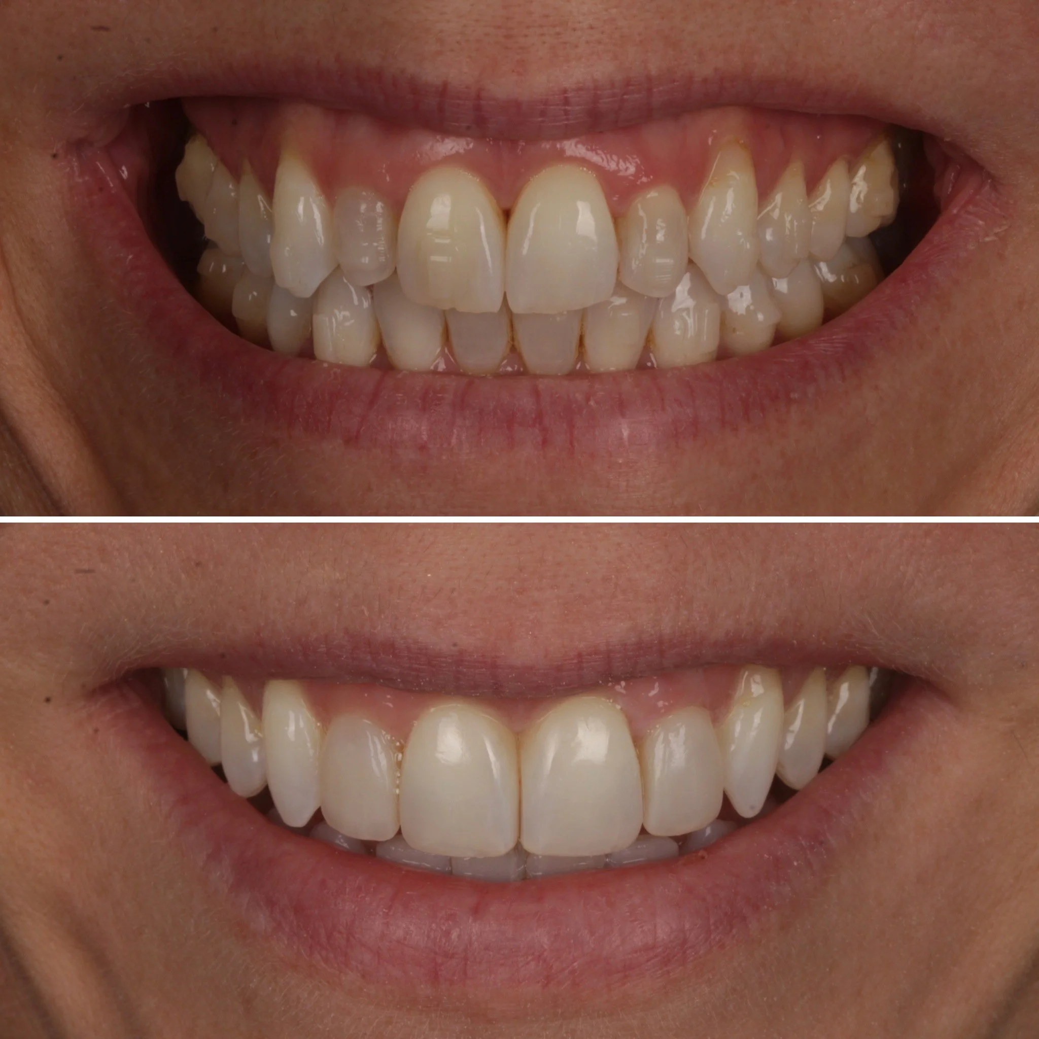 Comparison of teeth before and after dental treatment, showing improved alignment and whitening.