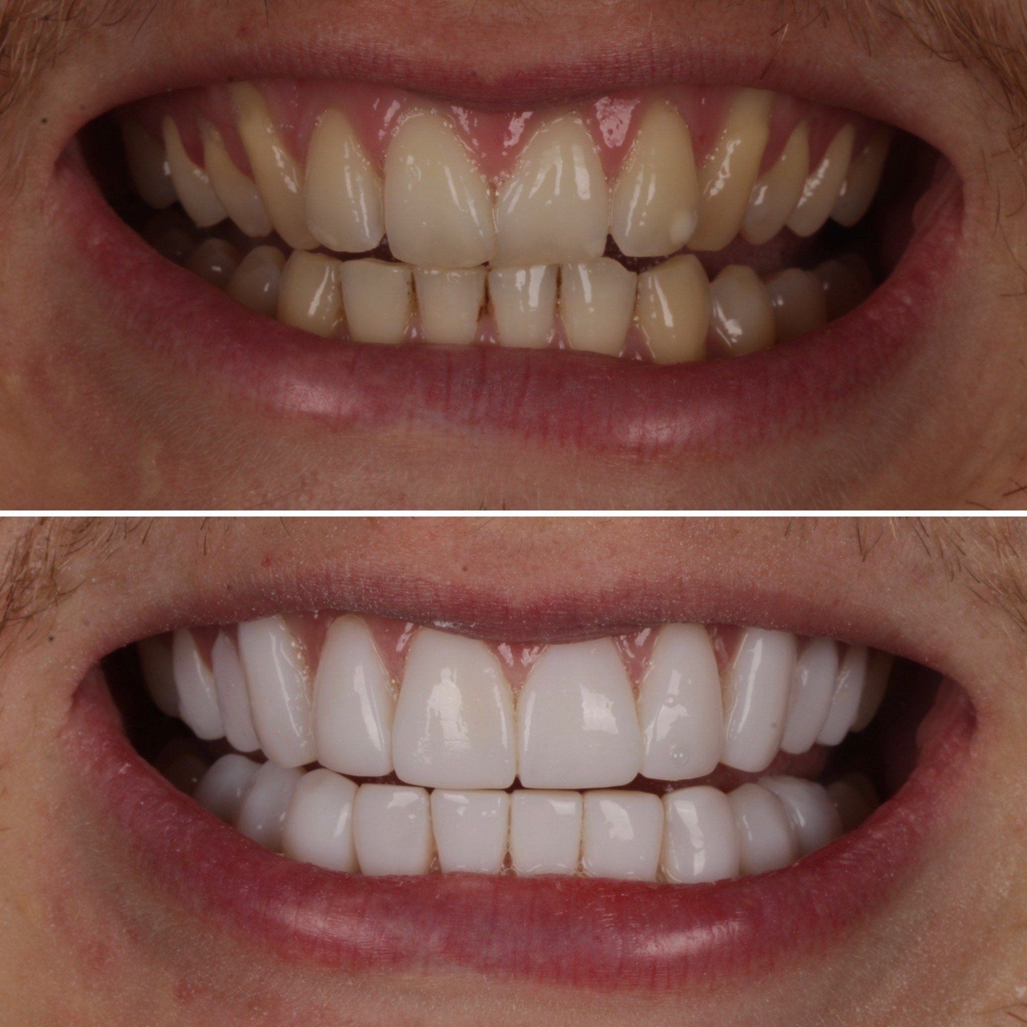 Comparison of a person's teeth before and after teeth whitening, showing significantly whiter teeth in the after photo.