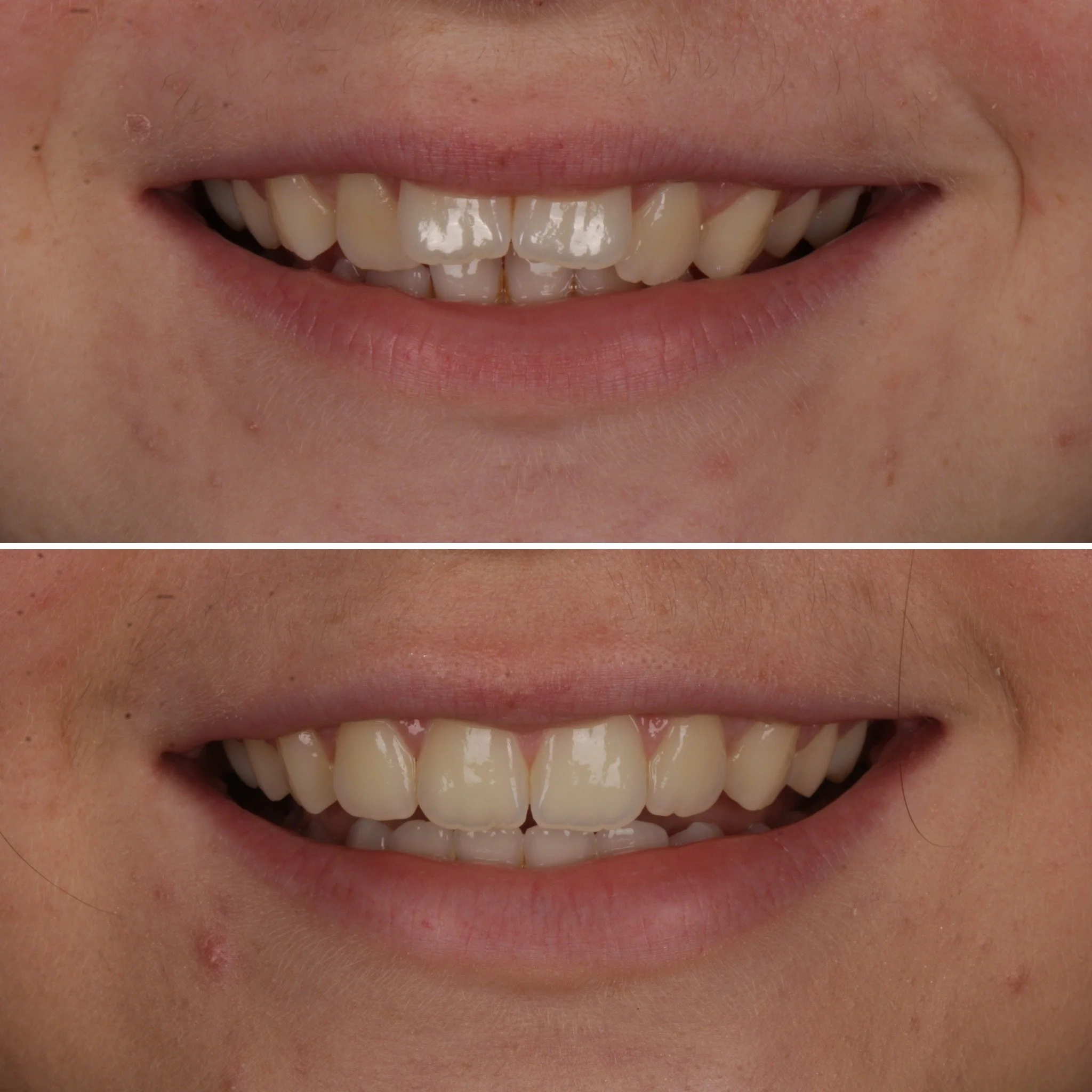 Close-up of a person's smiling mouth showing teeth, before and after dental work.