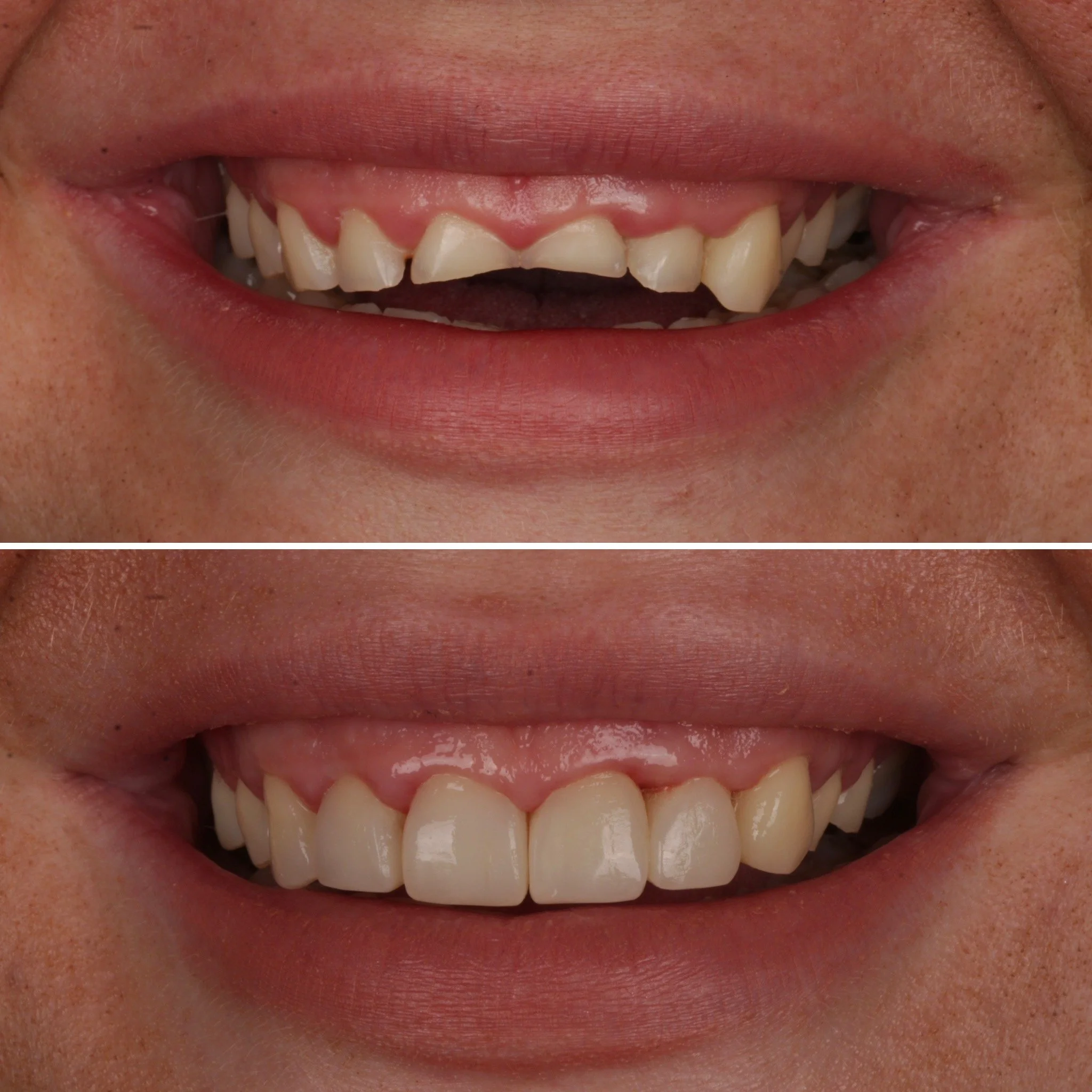 Close-up of a person's smile before and after dental treatment, showing improved teeth alignment and appearance.