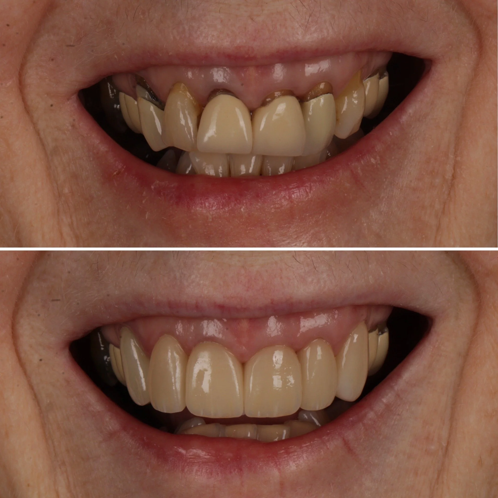 Close-up of a person's teeth and smile, showing stained and uneven teeth before and after dental cleaning or whitening.