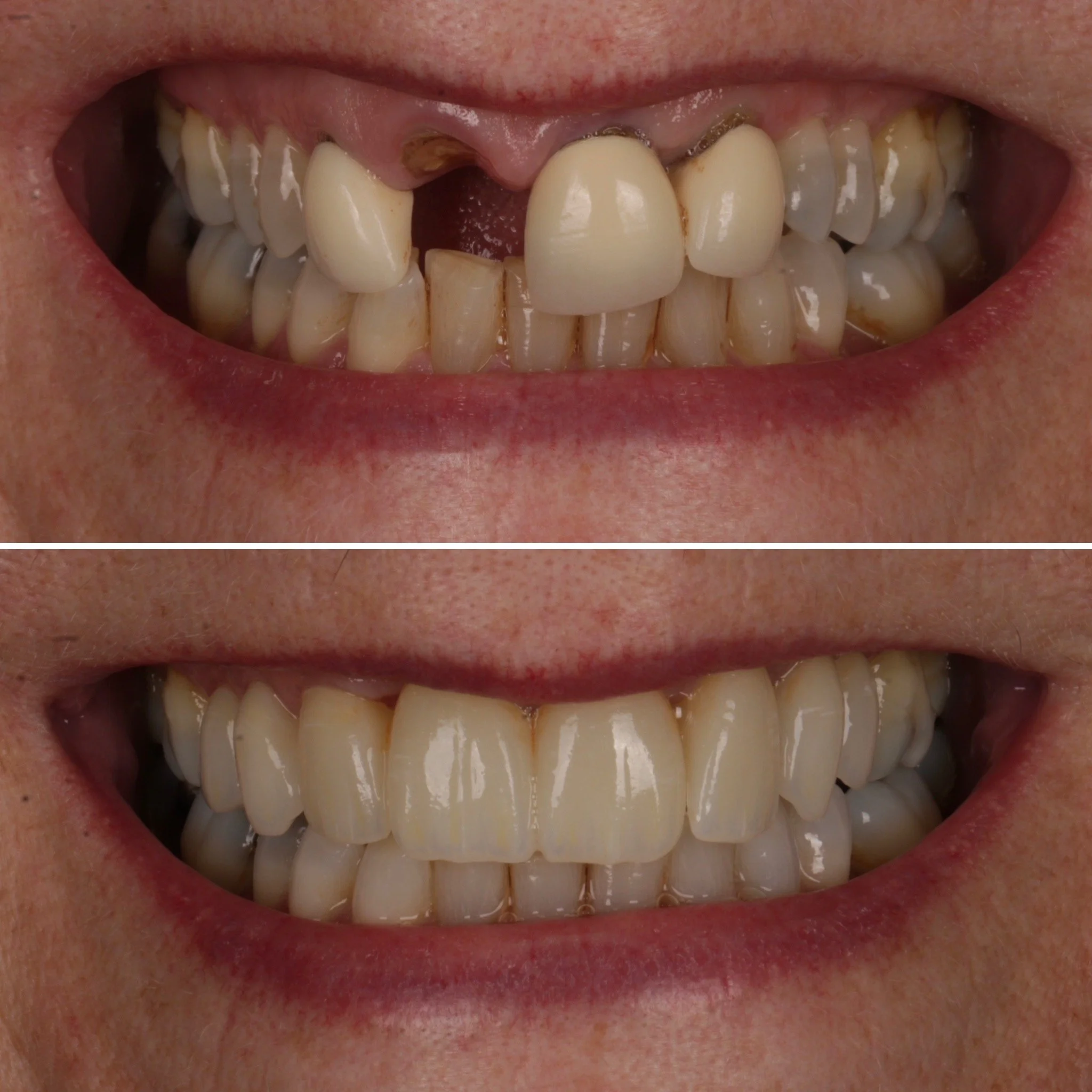 A comparison of a person's teeth before and after dental treatment, showing significant improvement in the alignment, color, and overall appearance of the teeth.