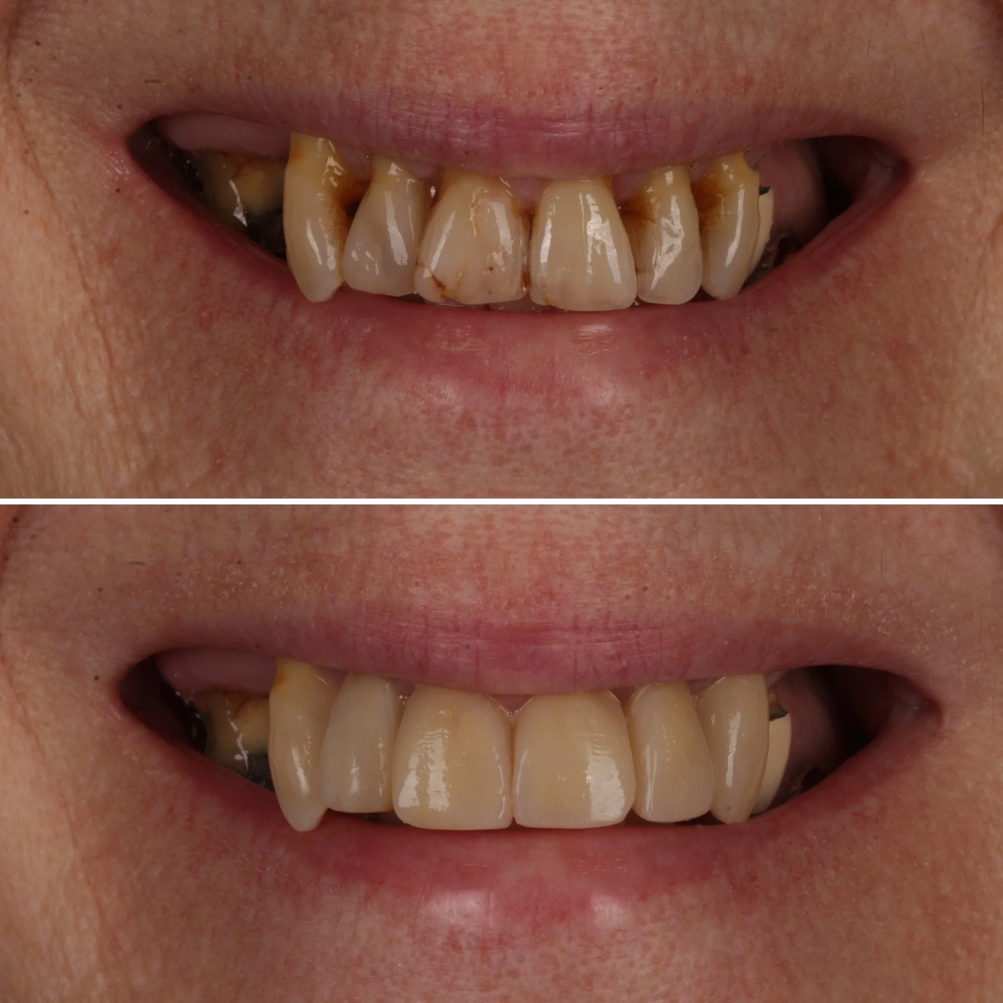 Before and after images of a person's smile showing dental improvements, with stained, crooked teeth in the top image and cleaner, straighter teeth in the bottom image.