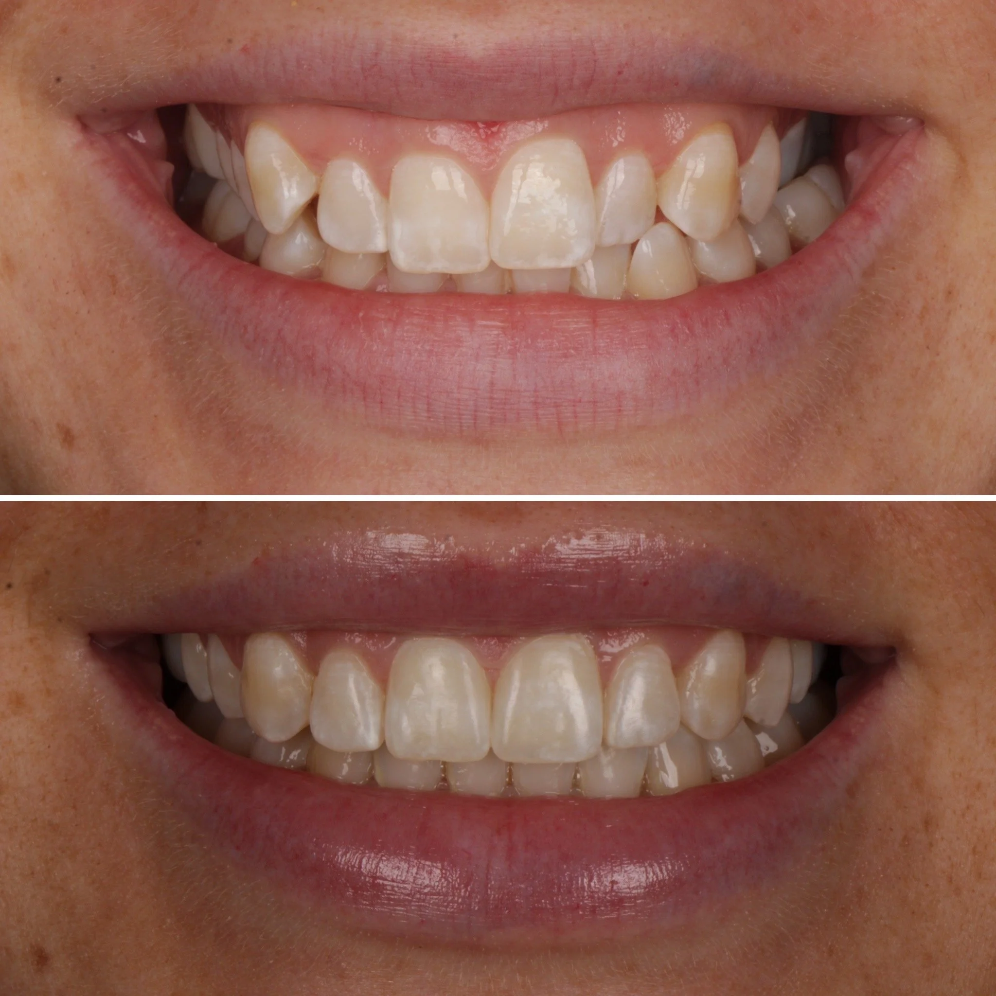Close-up of a person's smile showing their teeth before and after dental whitening treatment.