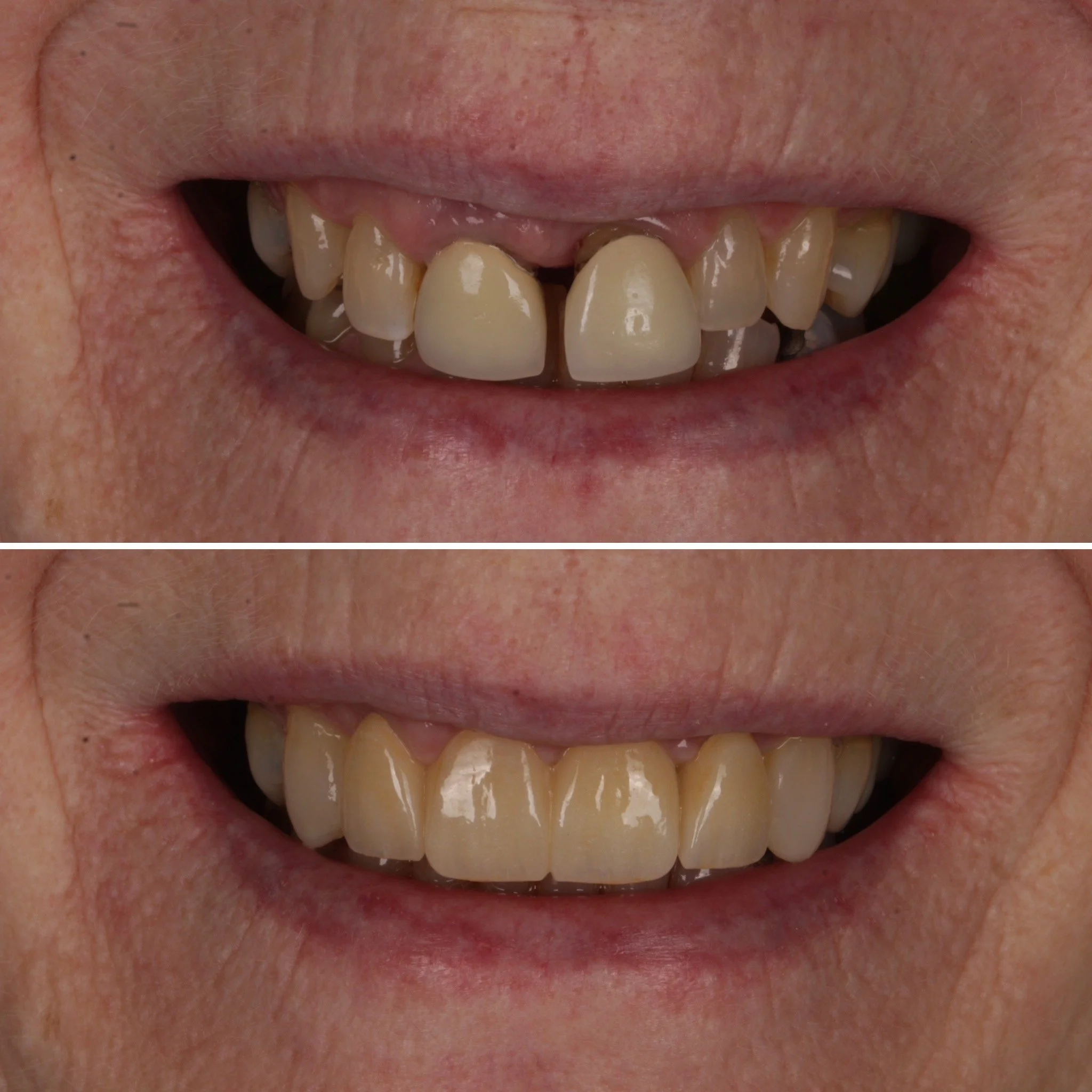 Comparison of teeth before and after dental restoration or whitening, showing improved appearance in the lower image.
